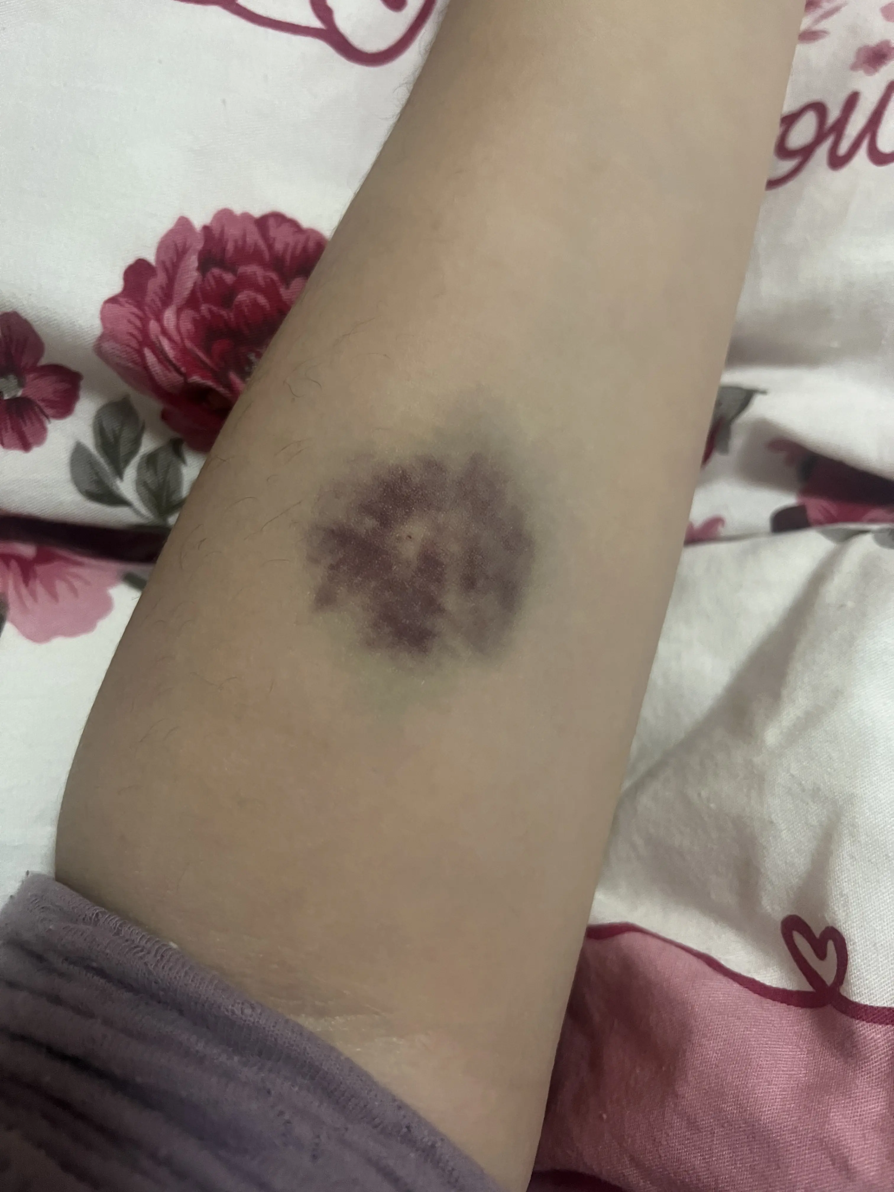 本人于高考血检时,因护士抽血扎针经验不足,导致可能是血管破损,造成