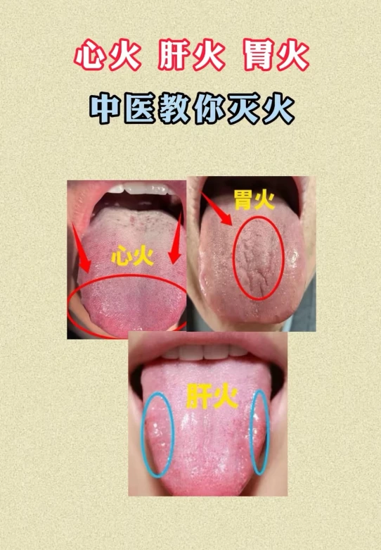 五脏有火,舌先知!心火、肝火、胃火的舌头什么样? - 哔哩哔哩