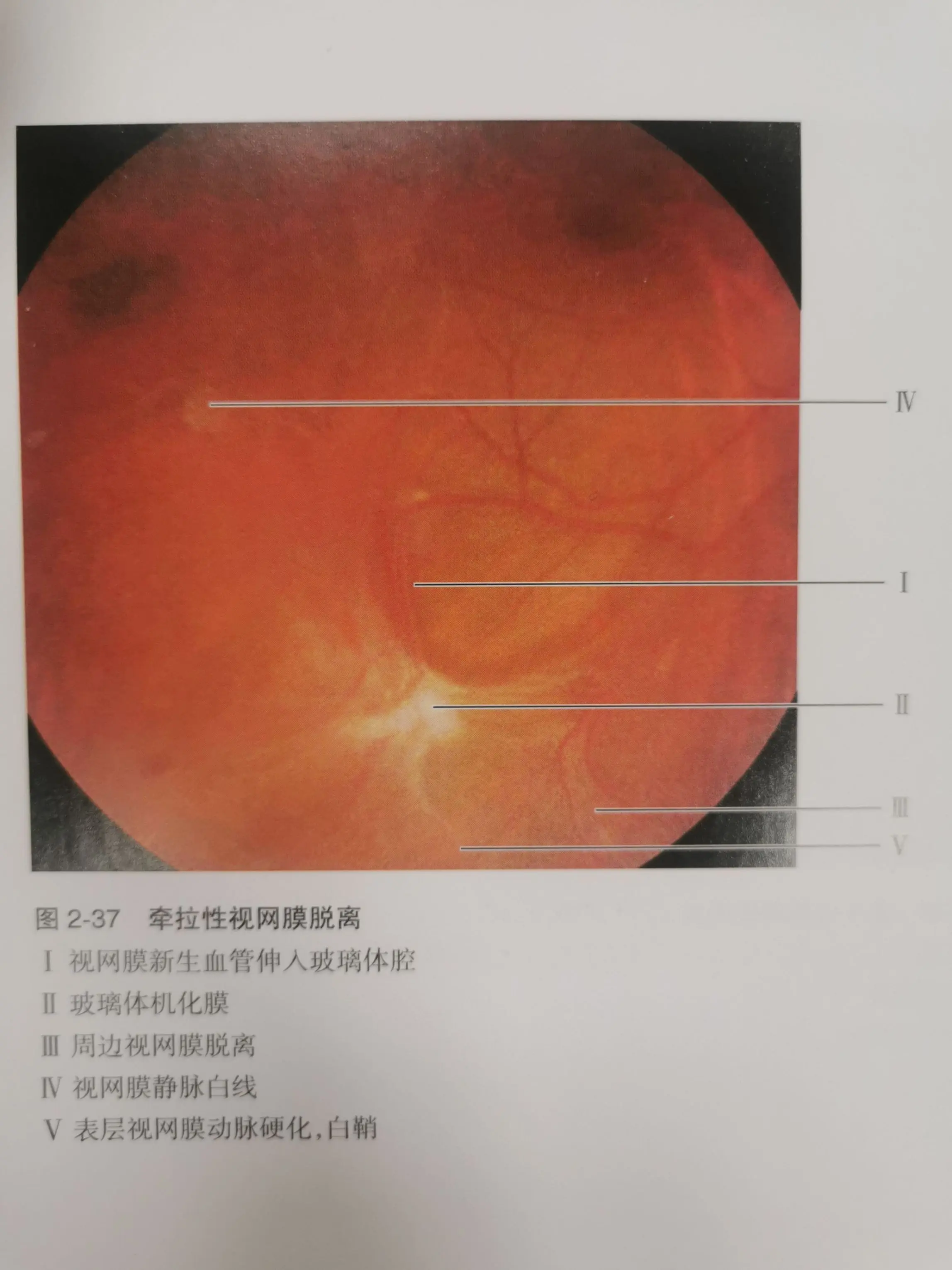 羟氯喹眼底病变图片