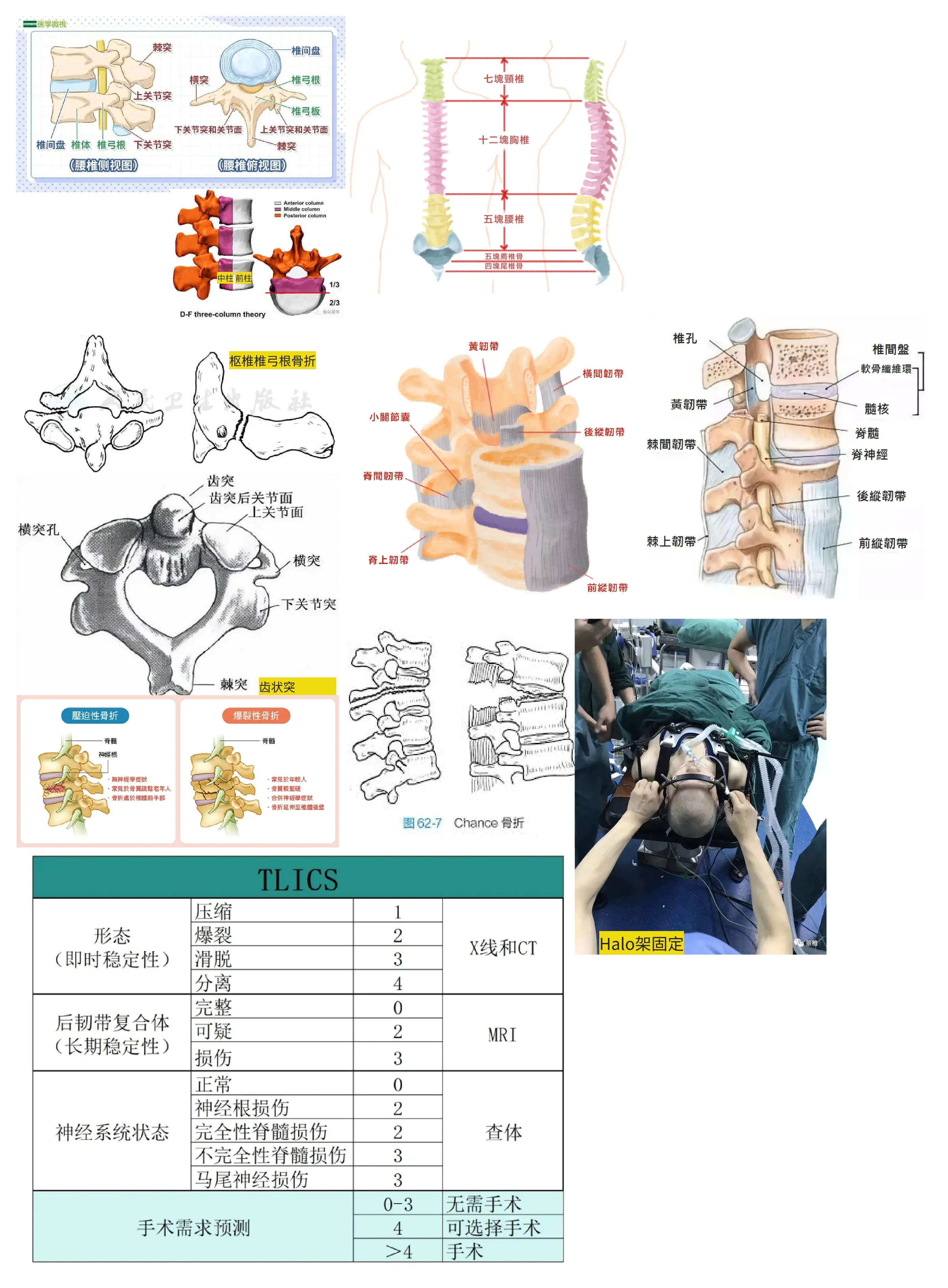 31-3-1-外科护理学-脊柱骨折