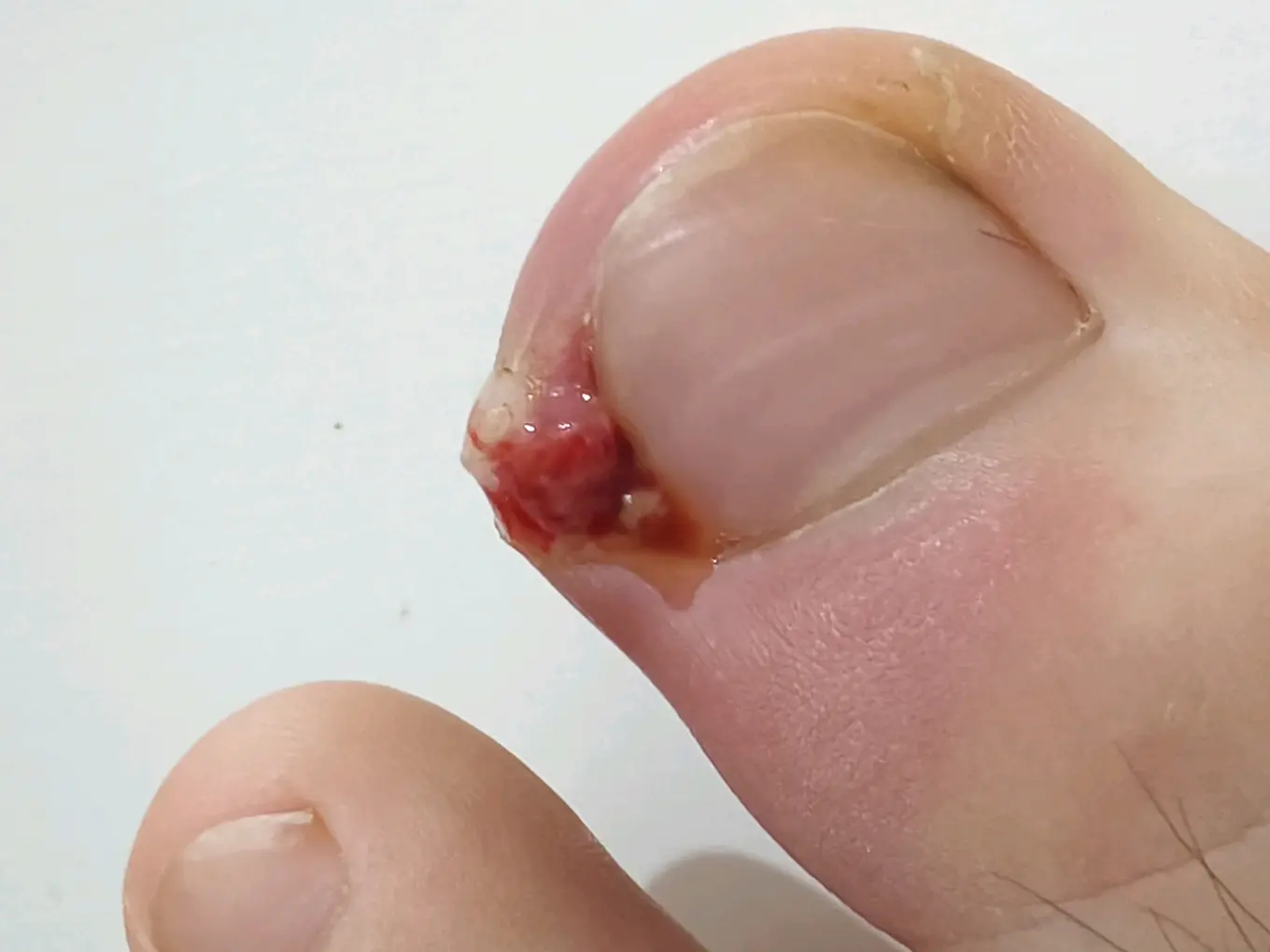 得了甲沟炎后越来越严重,现在不知道咋办了