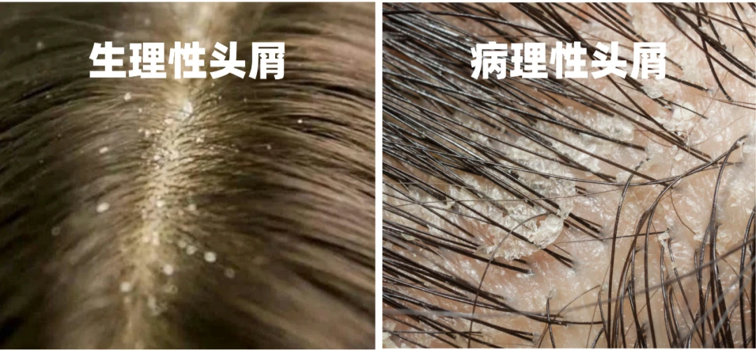 关于头皮极简护理，长发小寨有话说! - 哔哩哔哩