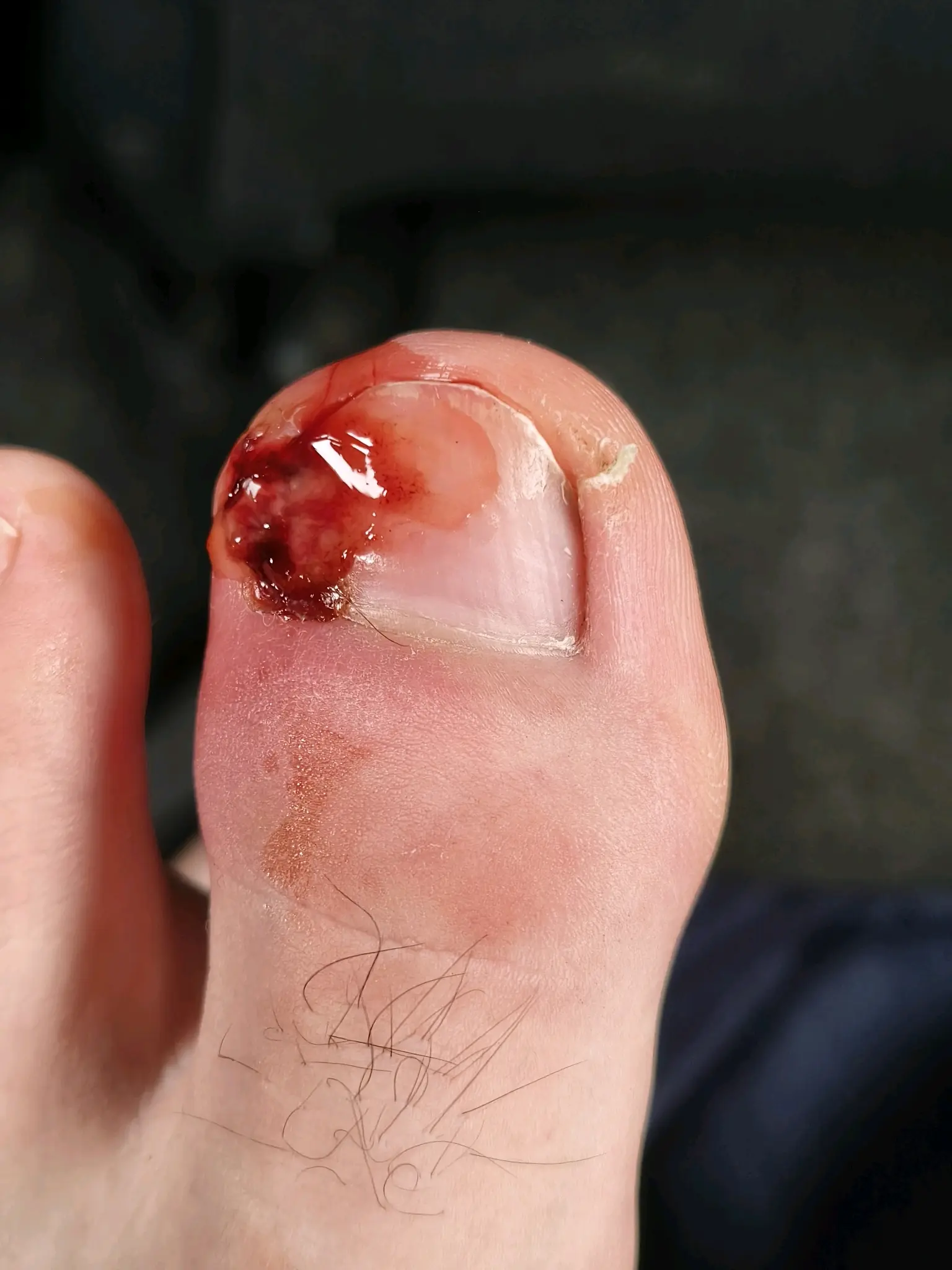 得了甲沟炎后越来越严重,现在不知道咋办了