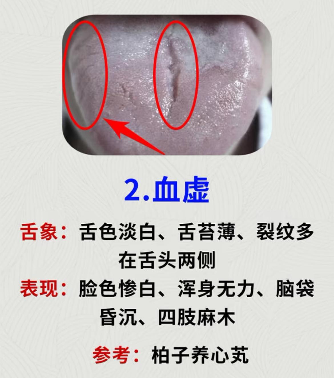 潘医生舌诊—实战分析:脾虚、血虚、气虚、阴虚、肾精亏虚 - 哔哩哔哩