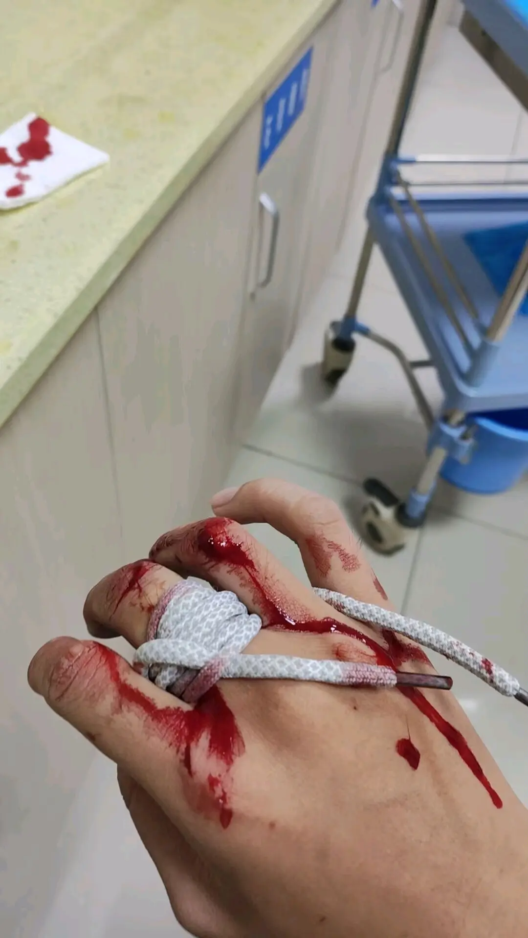 一个人在重庆,半夜被割伤手在医院缝针,血流不止只