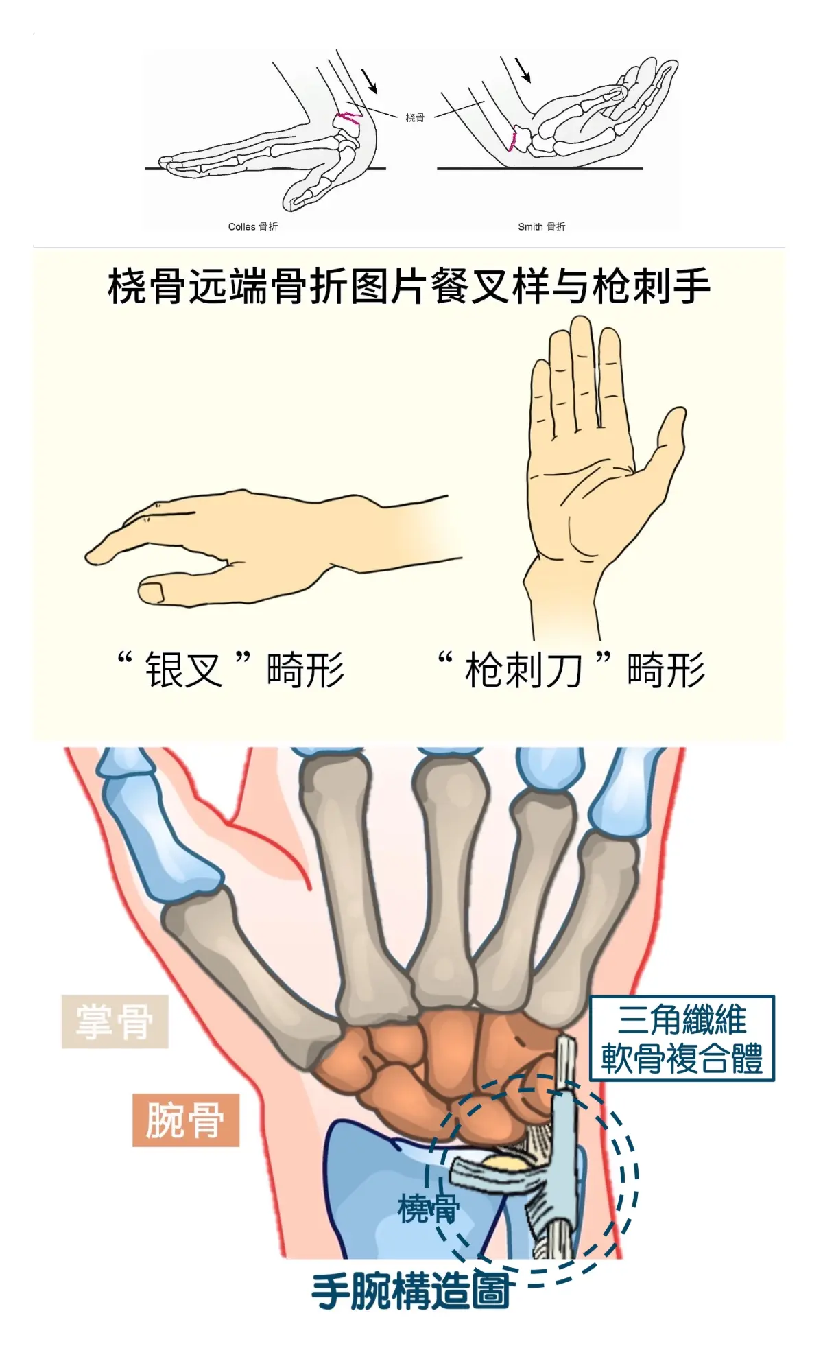 桡骨远端畸形图片