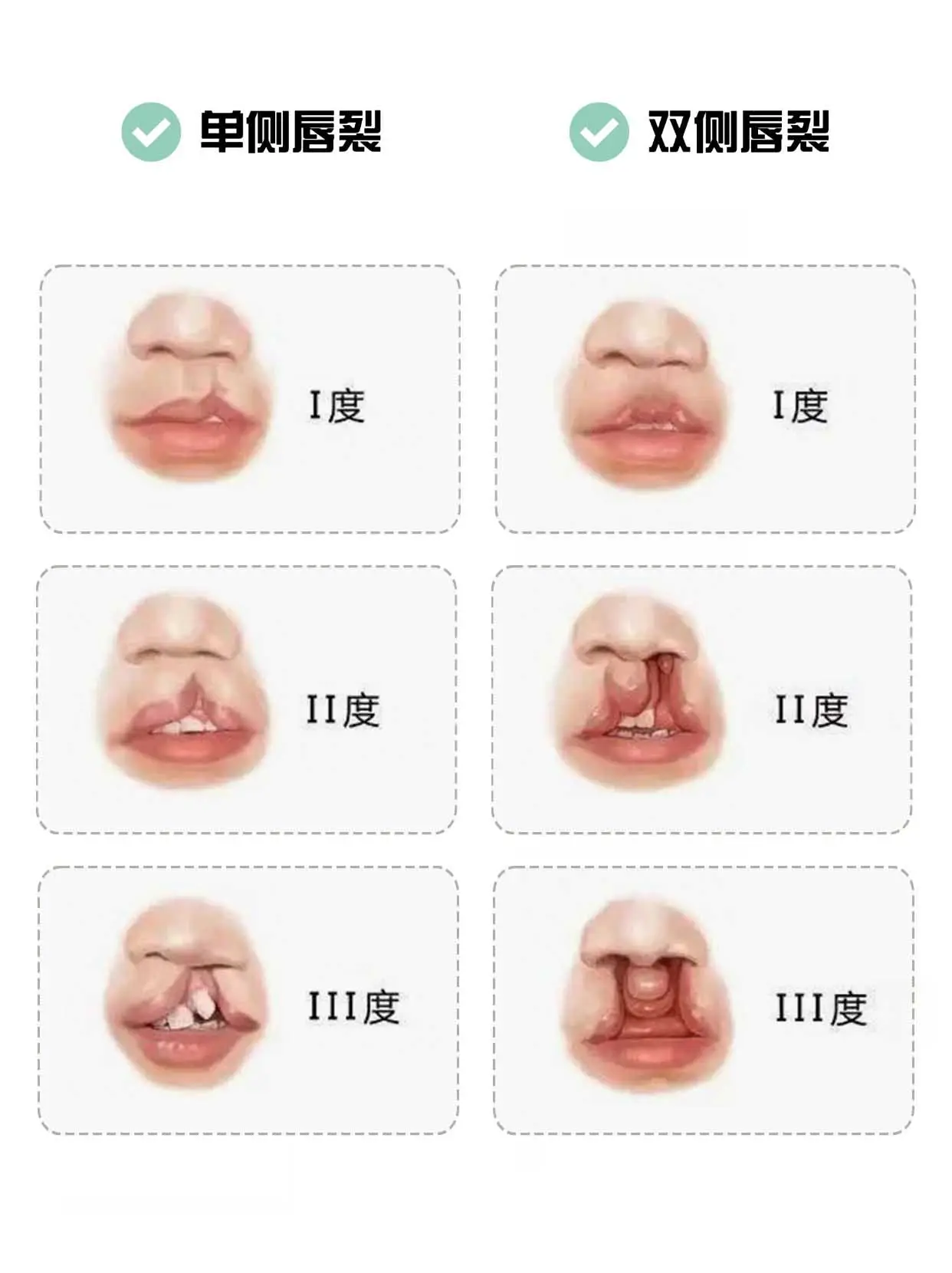 其实你根本就不了解唇腭裂