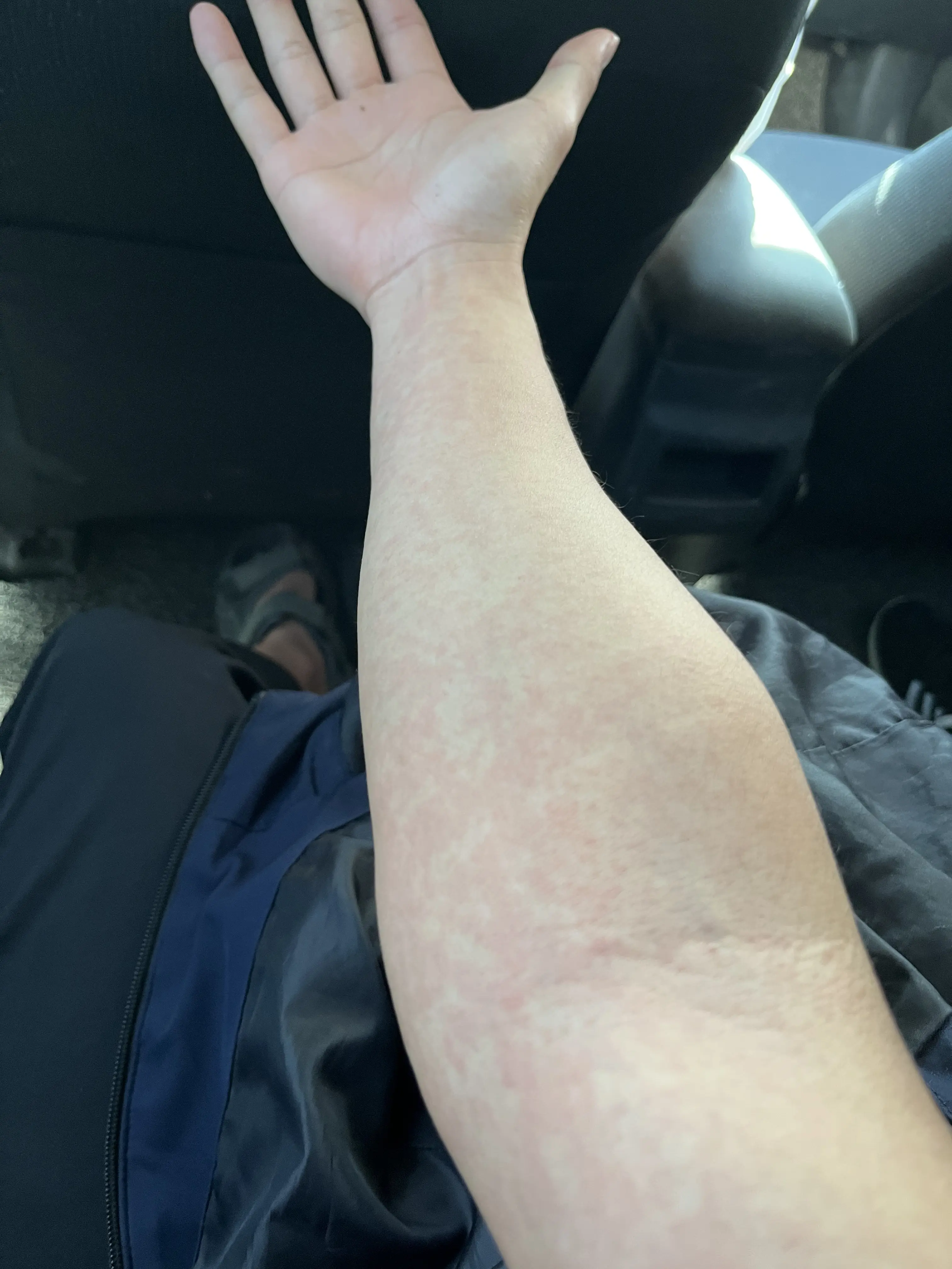 (起红疹了)事后复盘,其实我出现了很多登革热患者的典型症状,比如从未