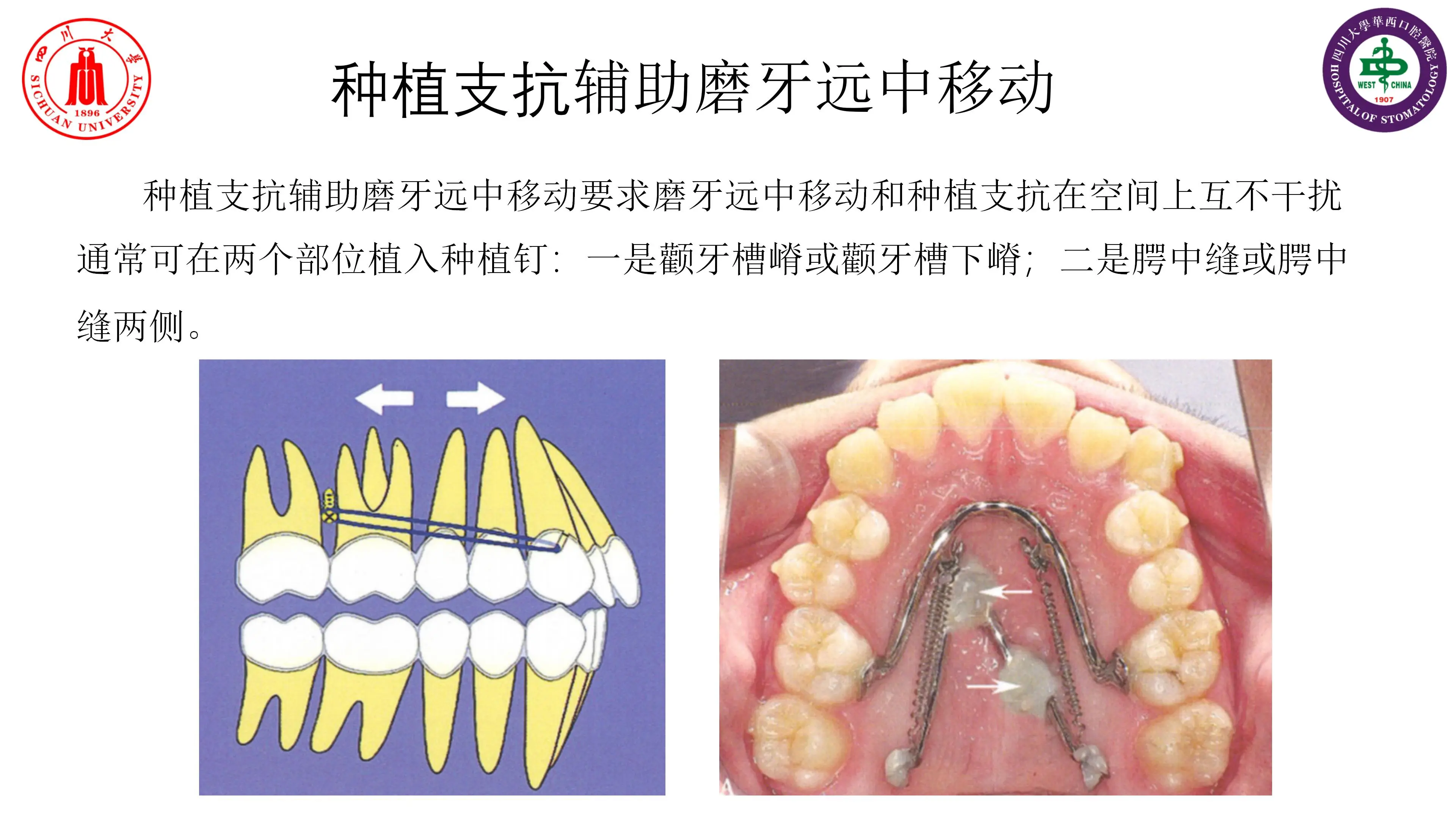 腭中缝图片