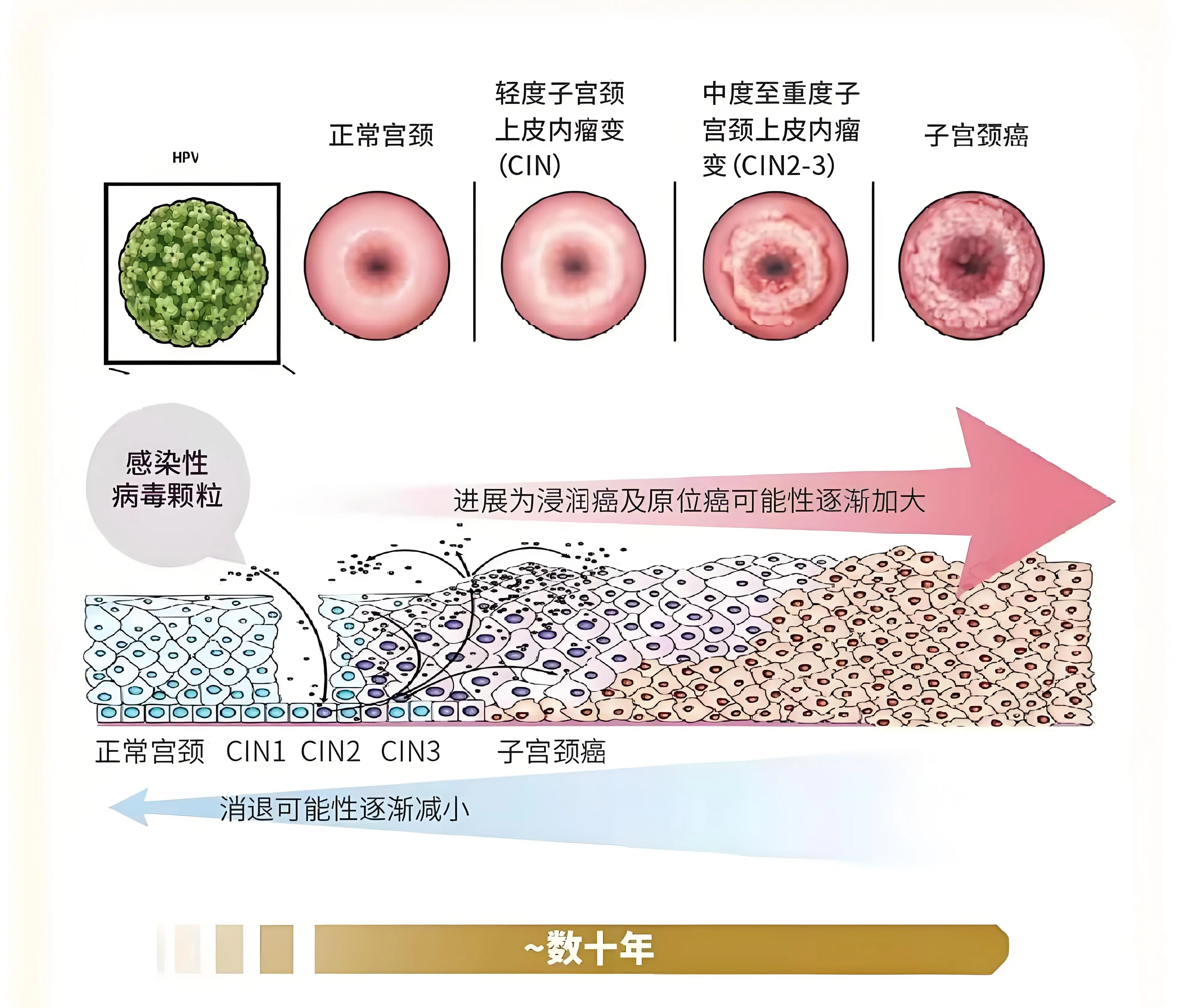宫颈病变通常包括宫颈上皮内瘤变(cin)和宫颈原位癌等.