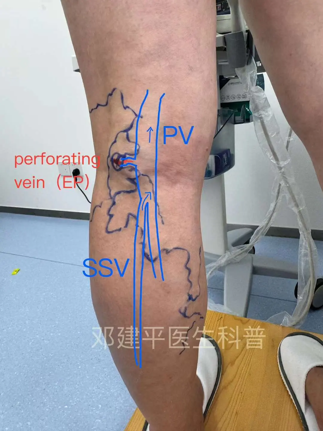 腘窝静脉曲张图片