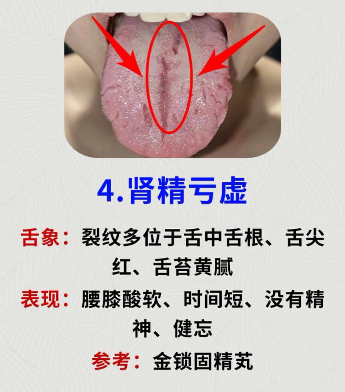 潘医生舌诊—实战分析:脾虚、血虚、气虚、阴虚、肾精亏虚 - 哔哩哔哩
