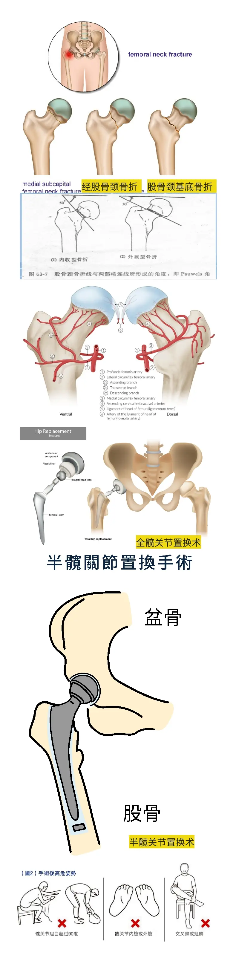 股骨颈骨折嵌插型图片图片