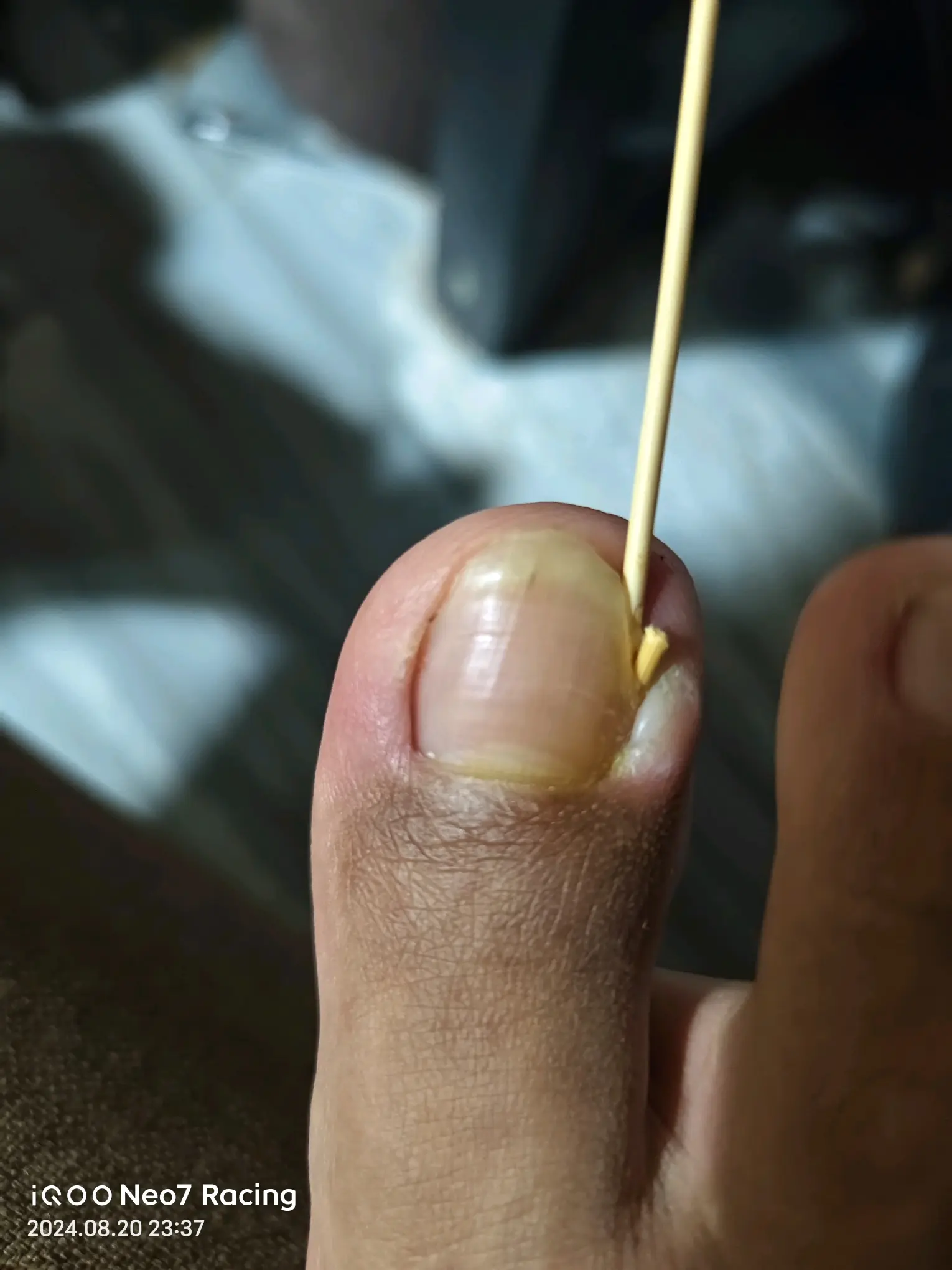 甲沟炎的一小时处理方式