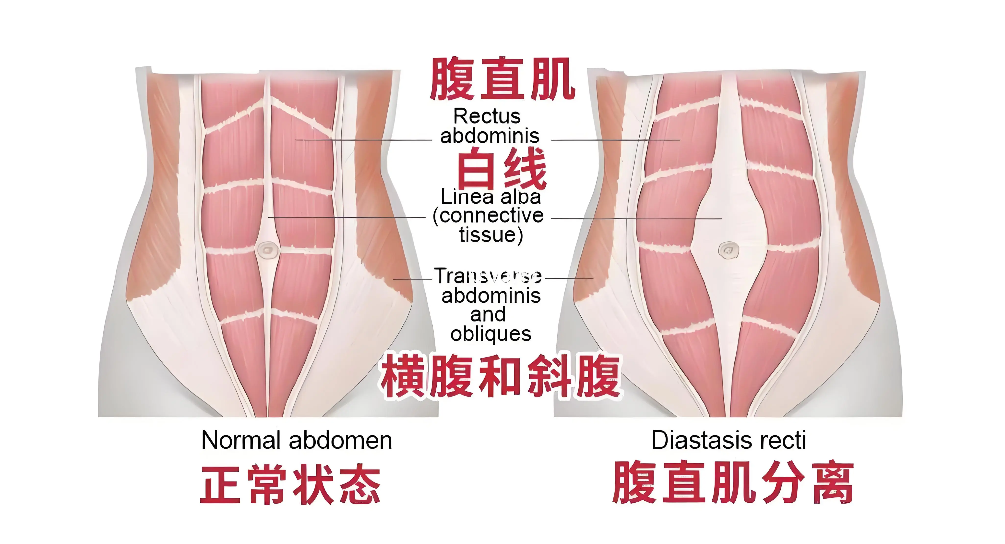 简而言之,就是腹部向外压力过大,导致两边的腹横肌,腹内外斜肌受到