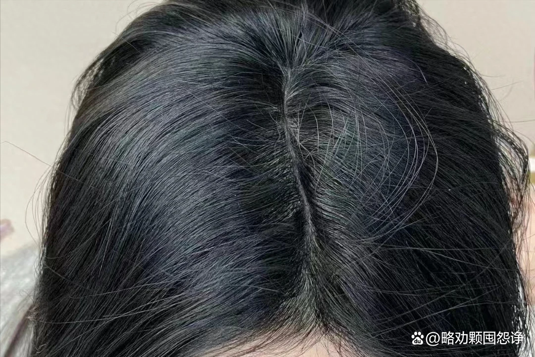 持续两个月,头发数量翻倍!秃头问题,发量多得令人难以置信! - 哔哩哔哩