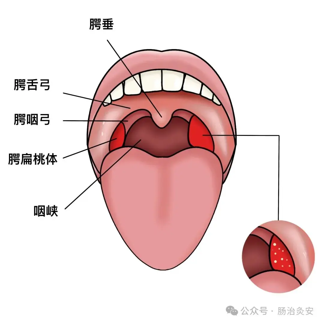 喉蛾,乳蛾,也就是常说的扁桃体炎.多数医家认为蟑螂有毒,蜈蚣也有毒
