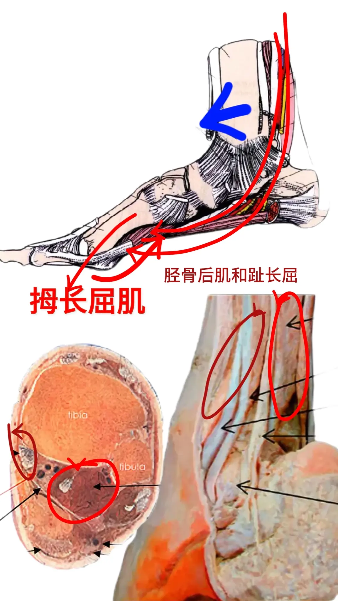 踝关节卡压拇外翻根骨内翻的关键拇长屈肌
