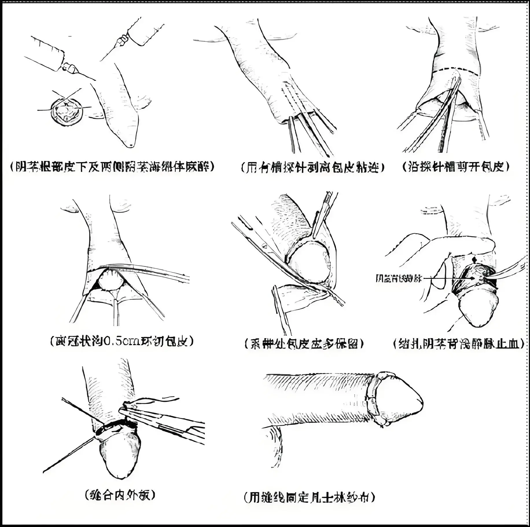 拿暑假寒假许多家长都给孩子流行做的"割包皮"手术来说吧