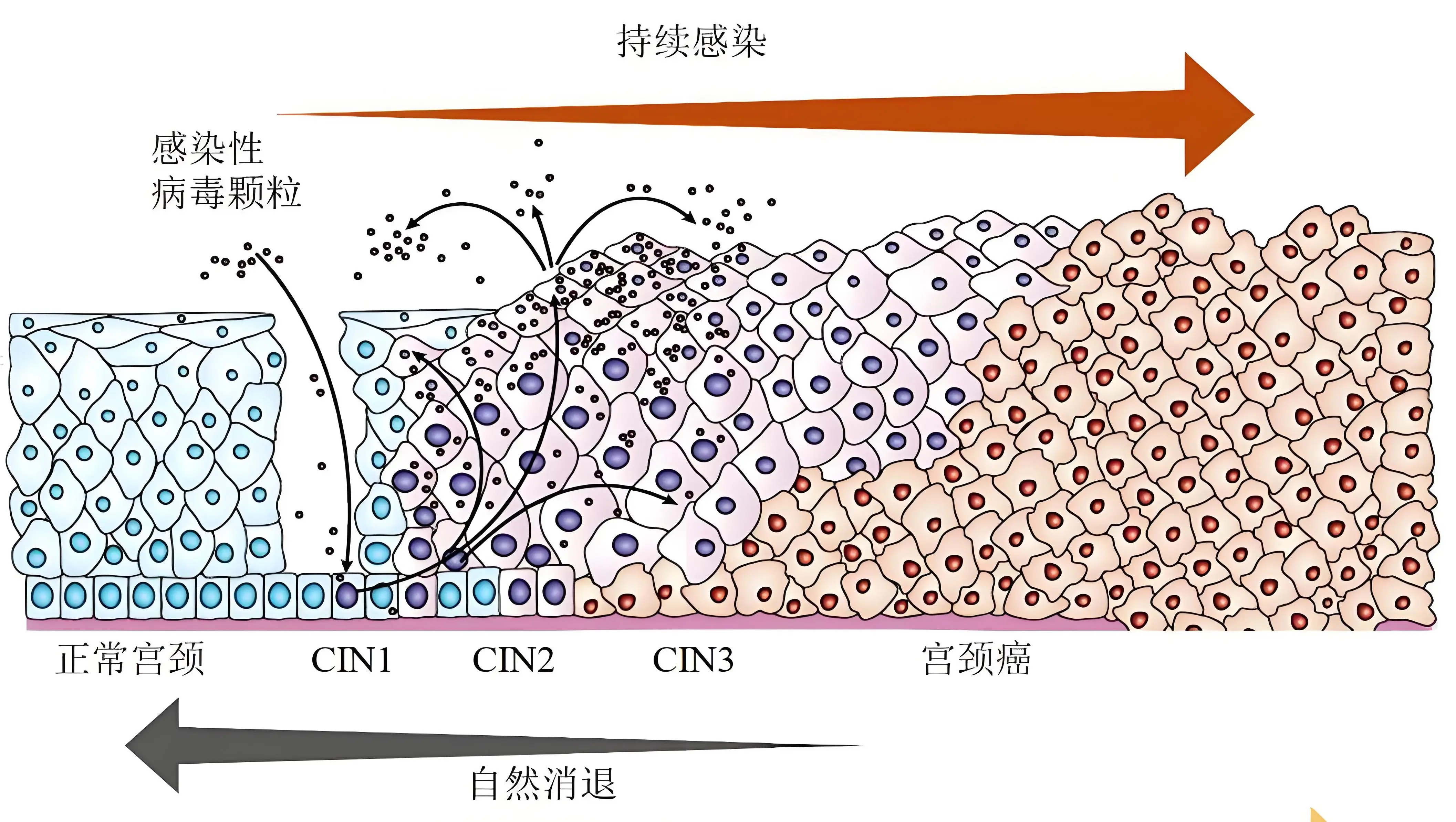 宫颈口长了颗粒图片图片