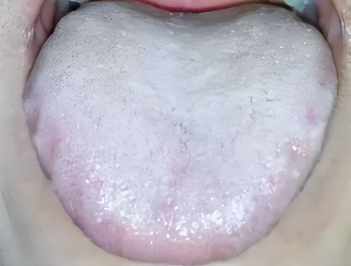 肾好不好就看舌根:舌根白没想法,舌根红时间短,舌根裂纹肾精亏