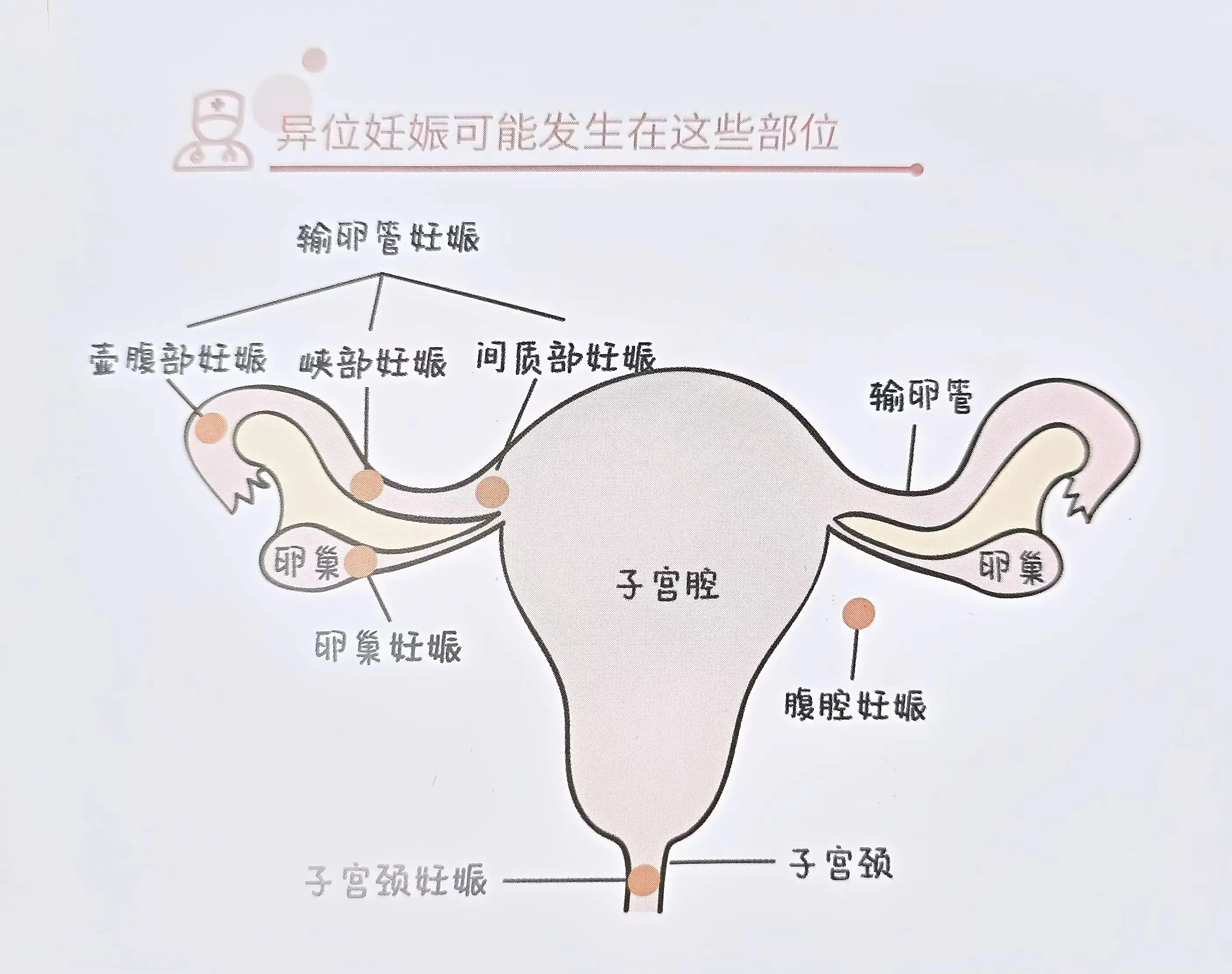 异位妊娠图片部位图片