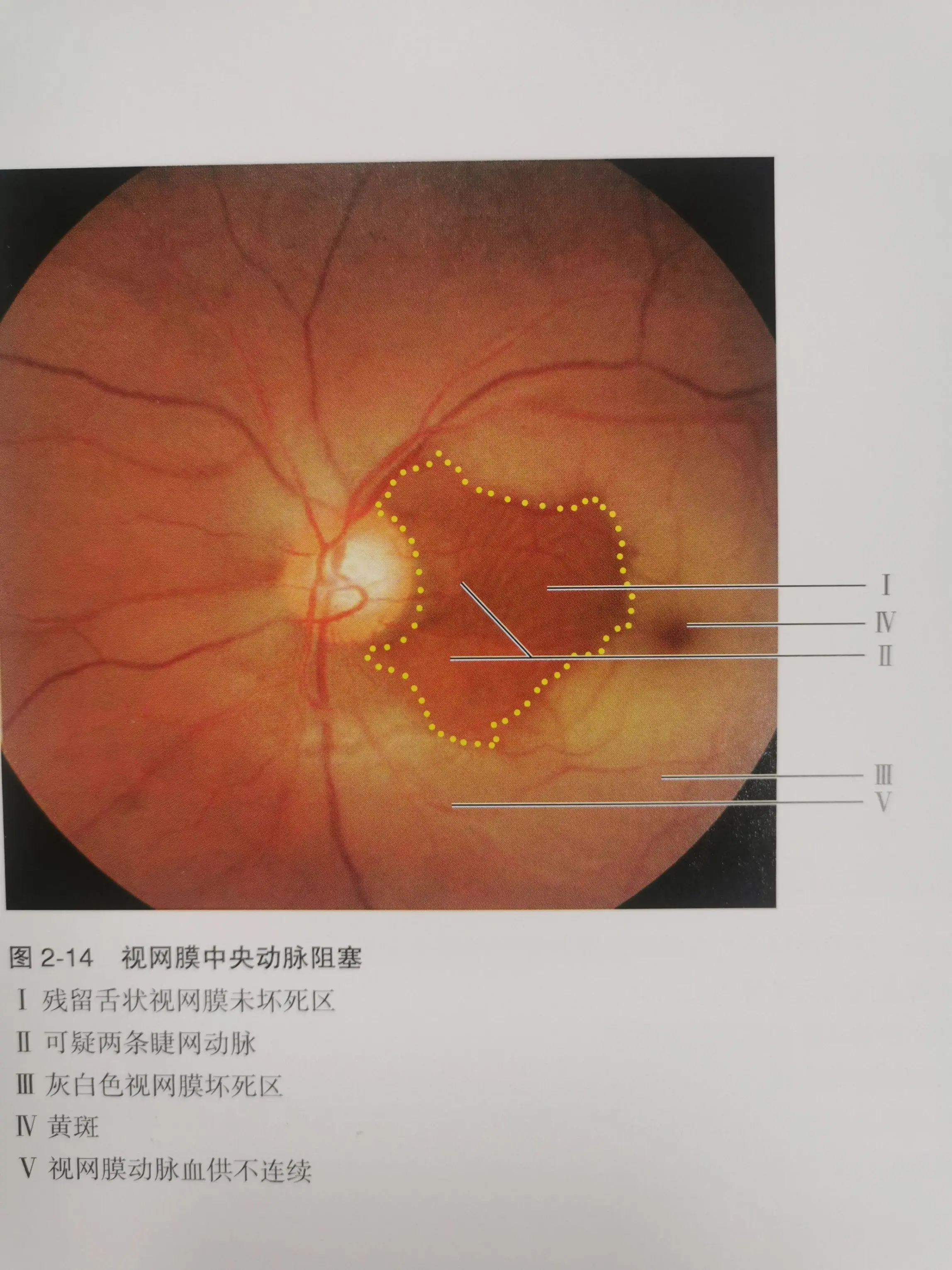 羟氯喹眼底病变图片