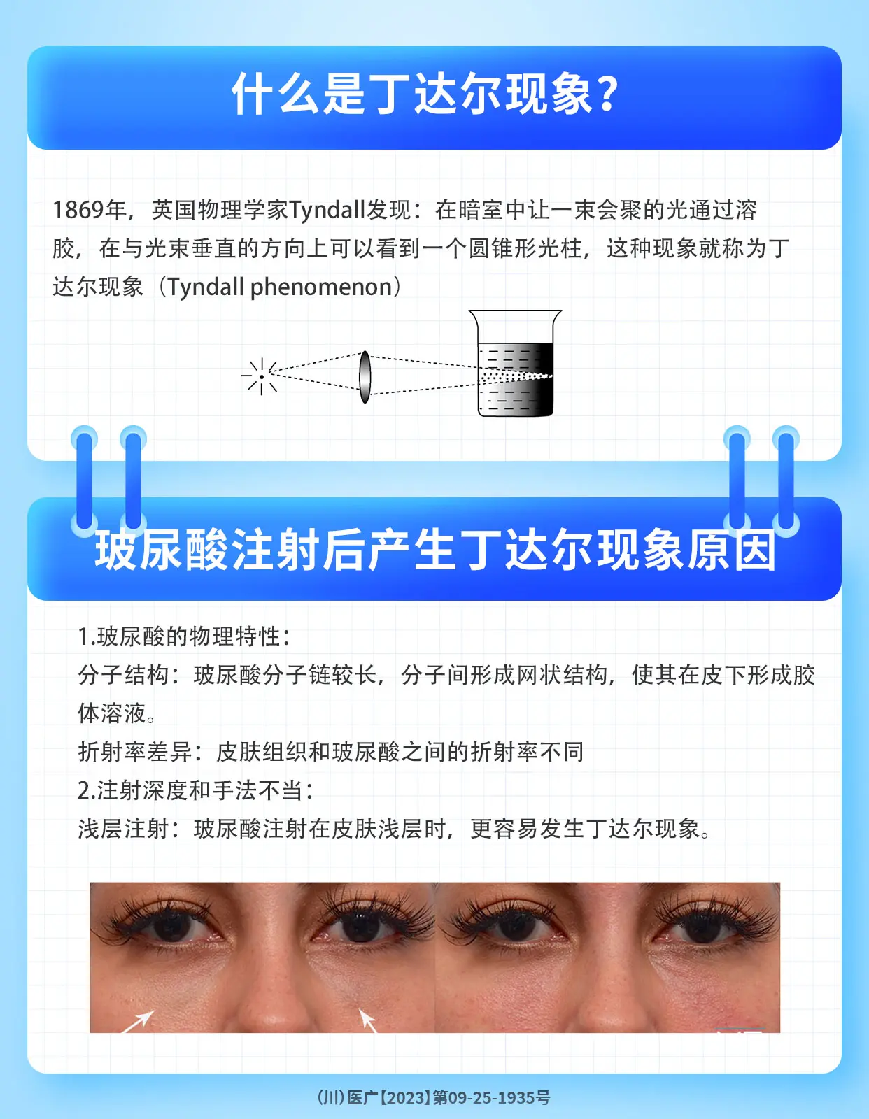 丁达尔现象玻尿酸图片