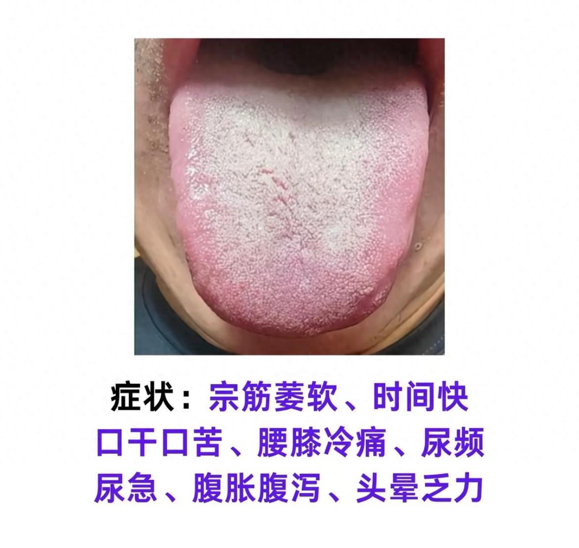 门诊四大肾虚舌象案例,跟崔大夫一起学舌诊,身体健康自己测! - 哔哩哔哩