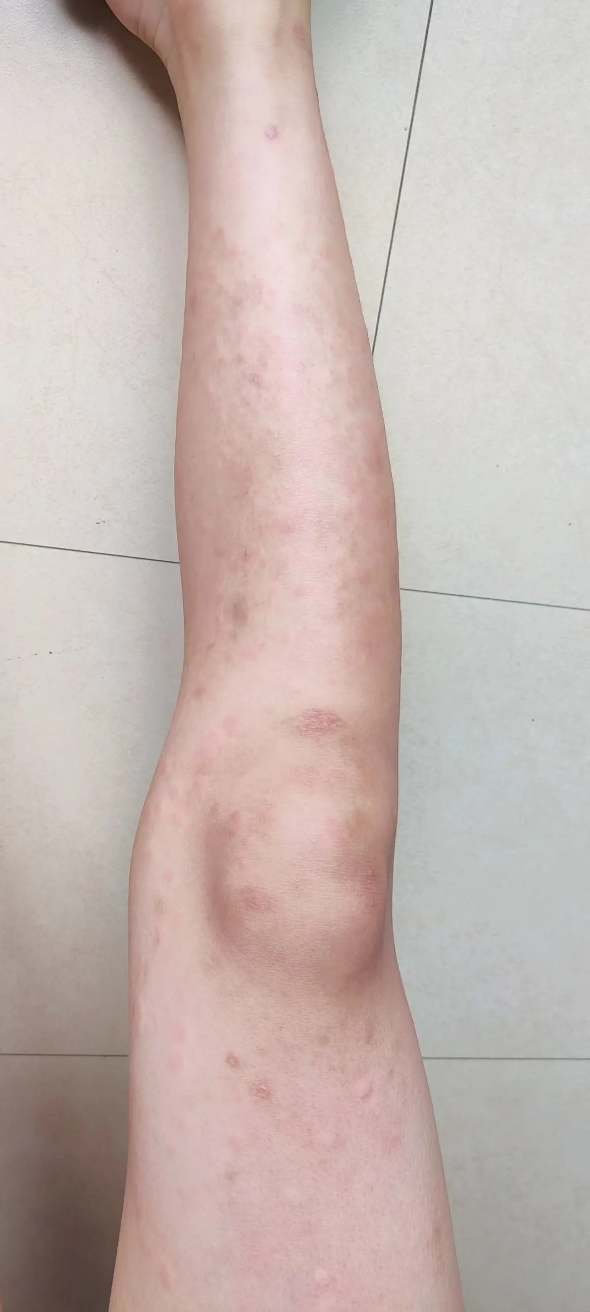 31小孩荨麻疹