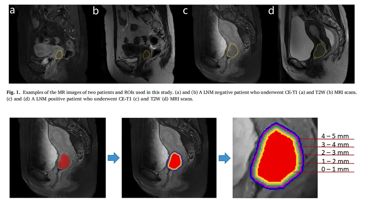 周日上午训练营直播讲解:mri分析早期宫颈癌术前预测淋巴结转移