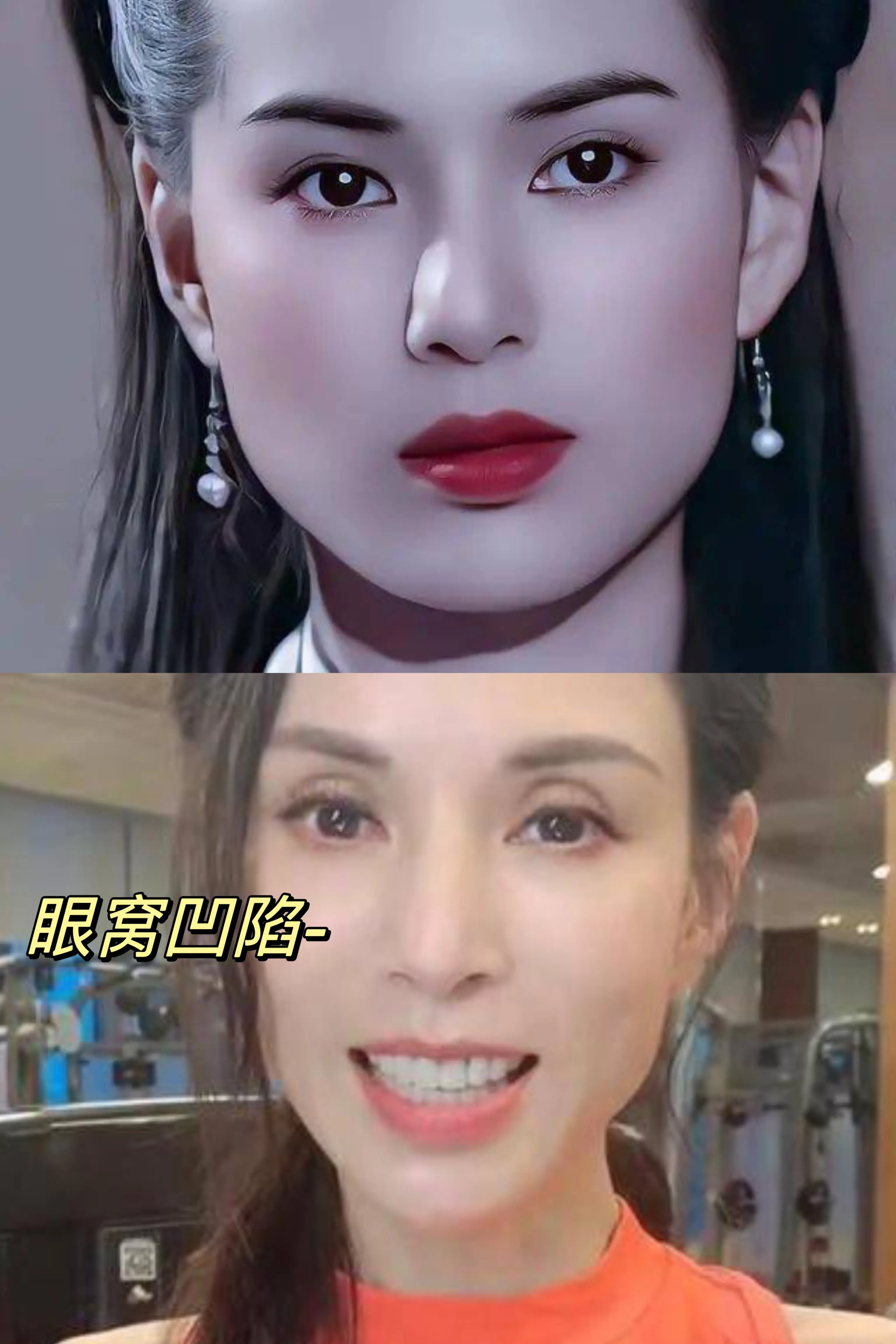 为什么双眼皮变宽,眼窝也变凹陷了?