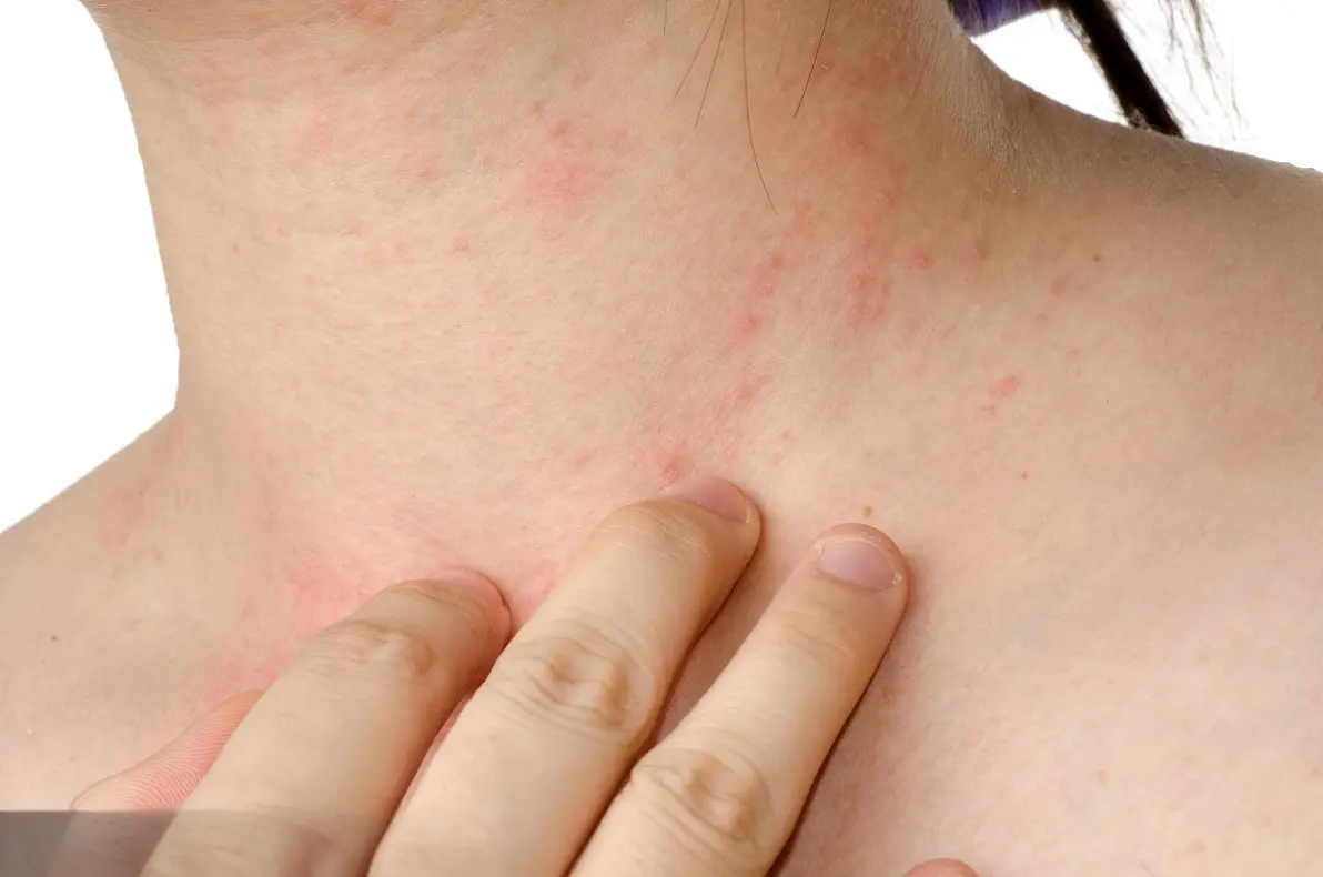 脖子上突发红疹瘙痒?专家揭秘常见病因及应对策略