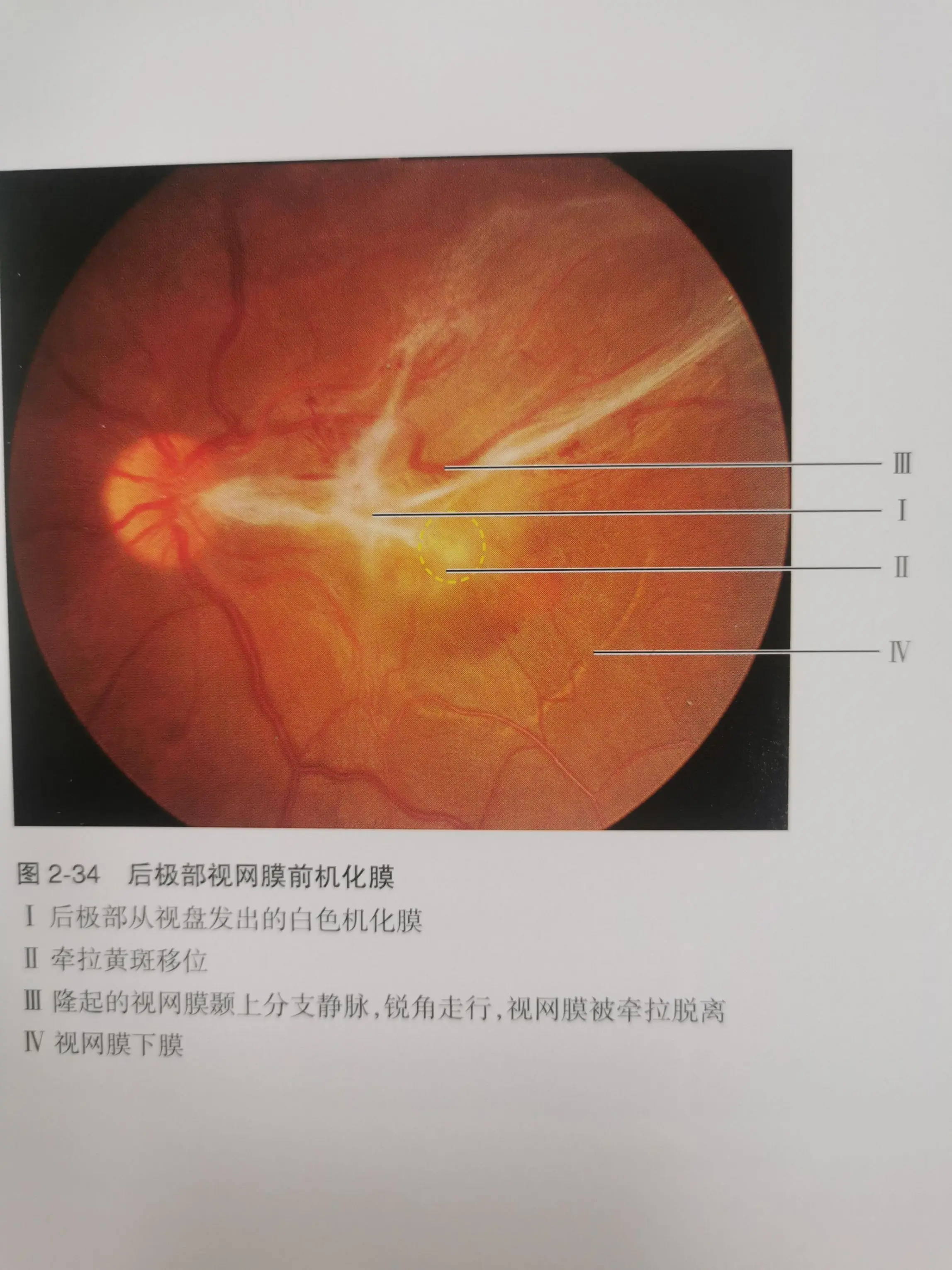 羟氯喹眼底病变图片