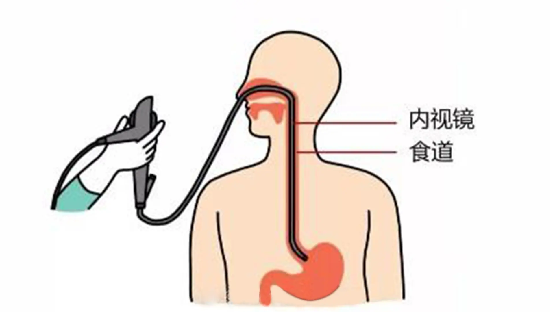 哪些情况需要做胃肠镜检查?永川肛肠医院