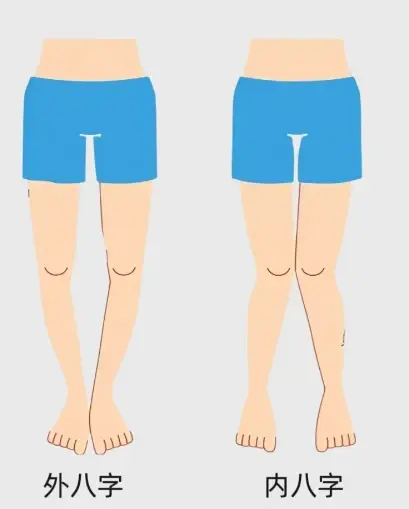 华脊道青少年体态健康内八外八对青少年的影响剖析