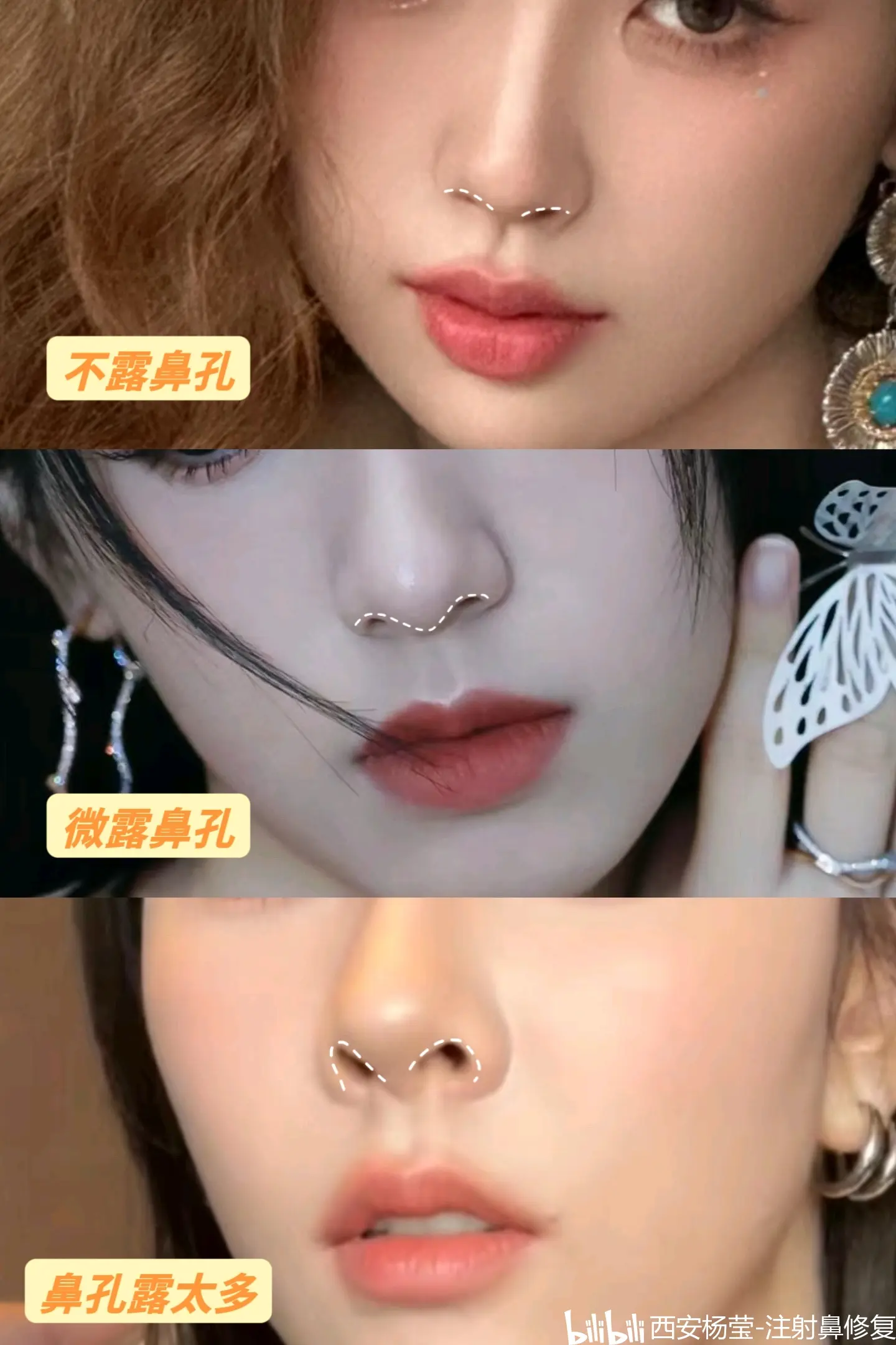 鼻孔外露的三种常见形态,谁更ok?