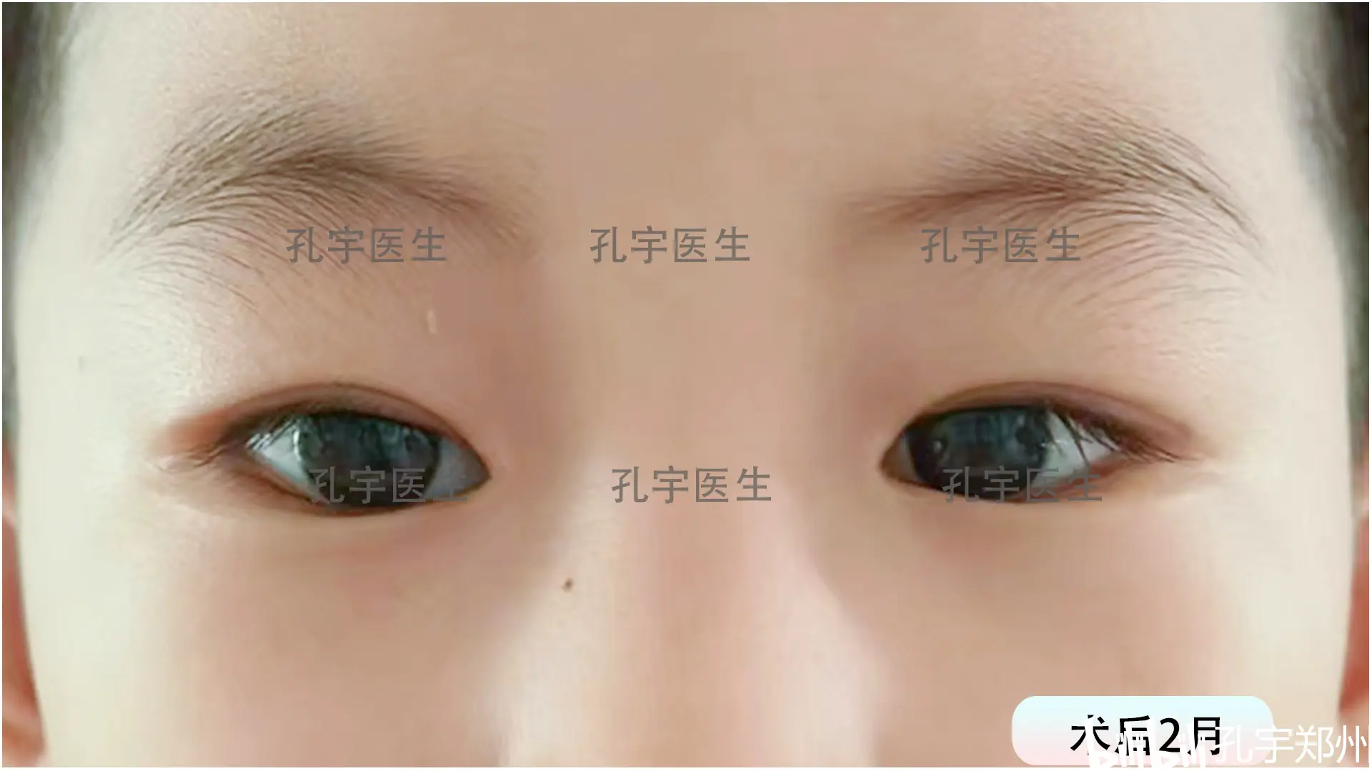 孔宇:5岁小帅哥,双眼先天性重度上睑下垂