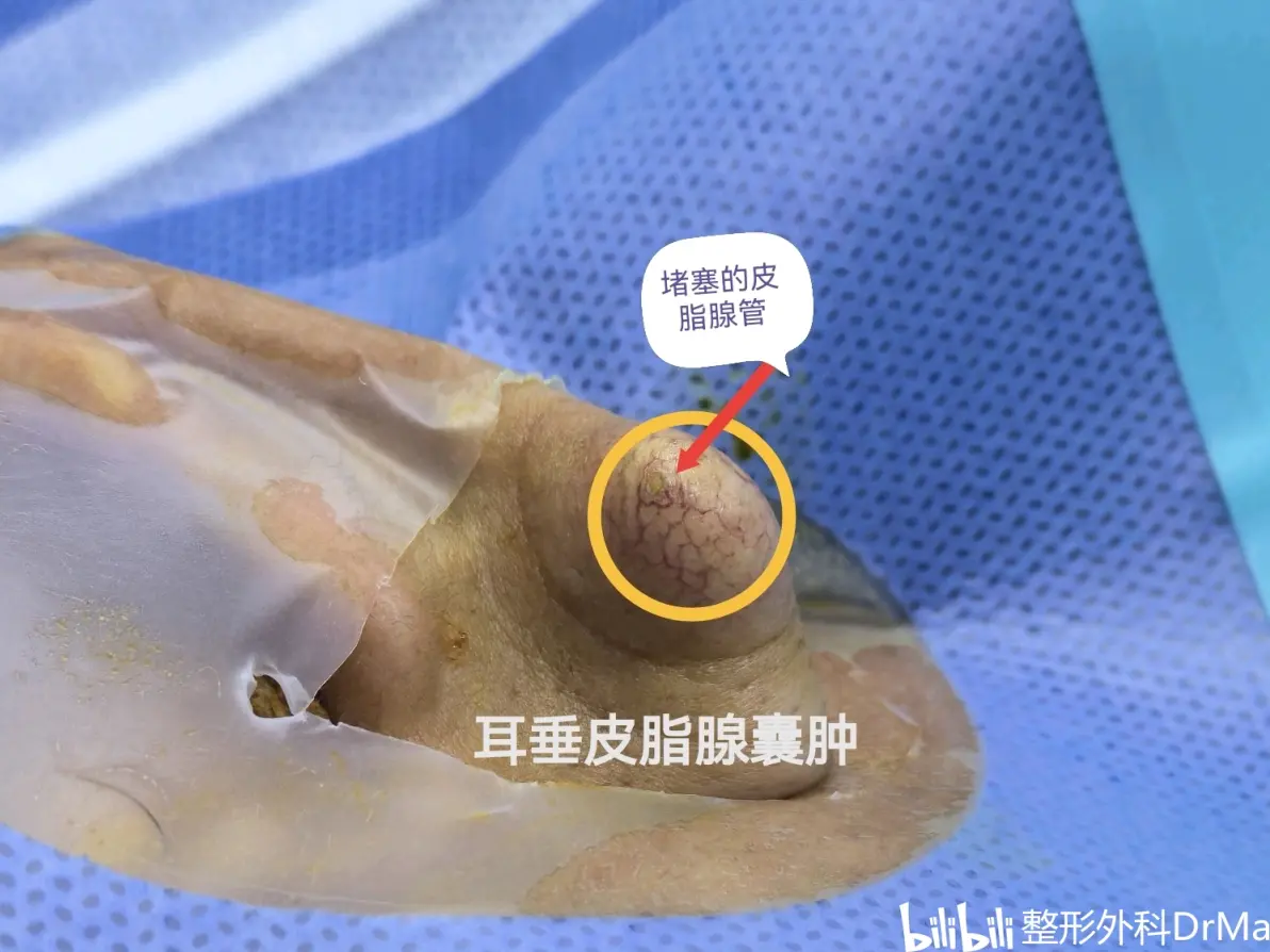 得了耳垂皮脂腺囊肿,就来沈阳市第四人民医院整形外科
