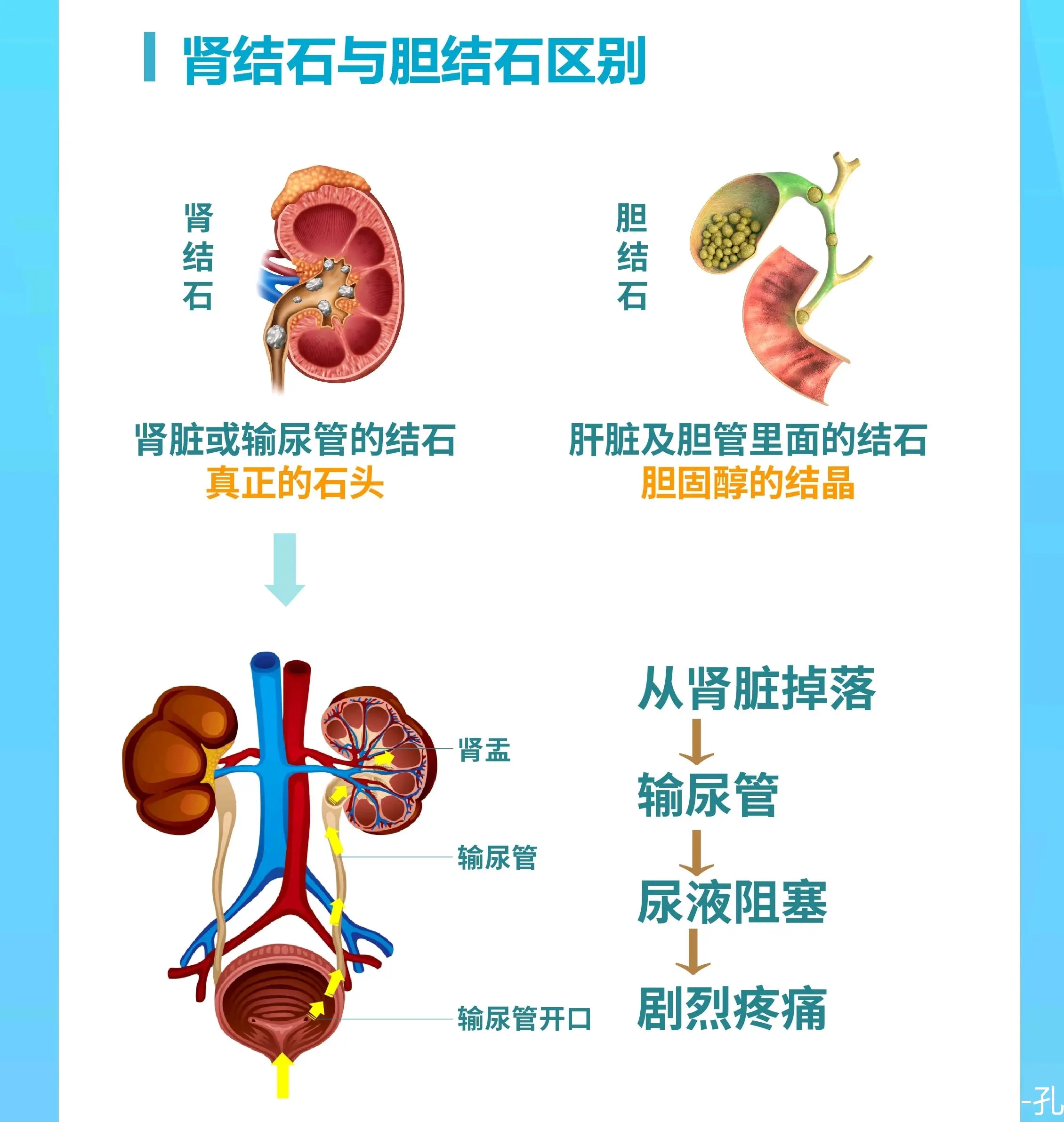 肾窦内结石图解图片