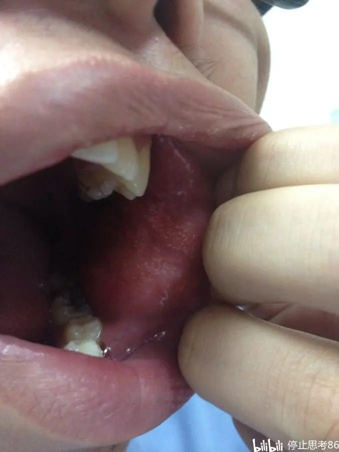 不可逆的口腔纤维化