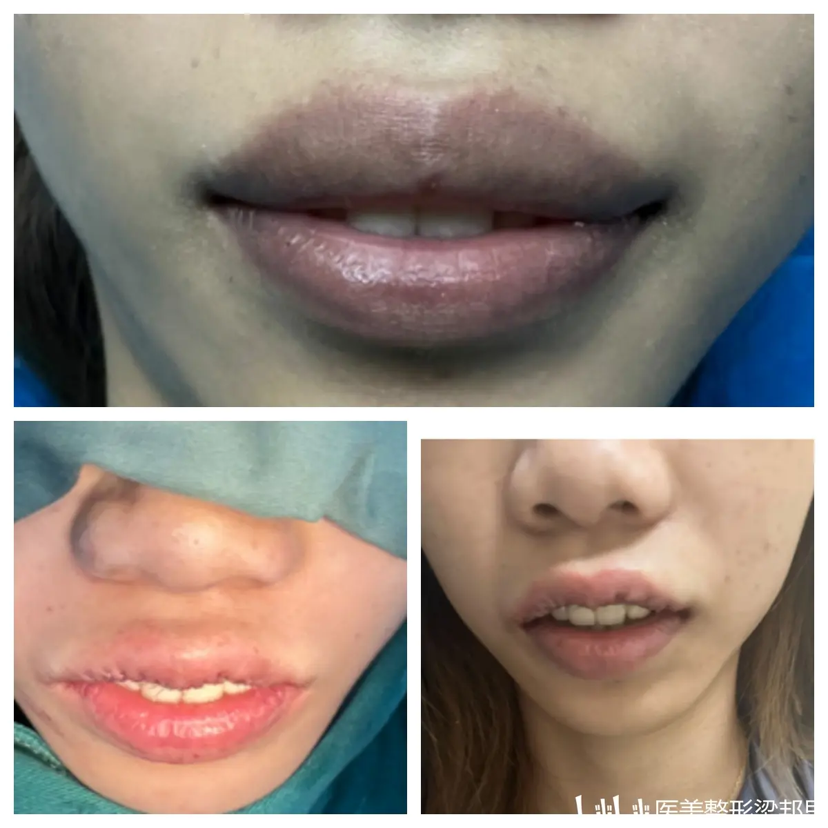 上唇唇综合术后即刻,术前上唇比下唇厚得很明显,外翻比较严重