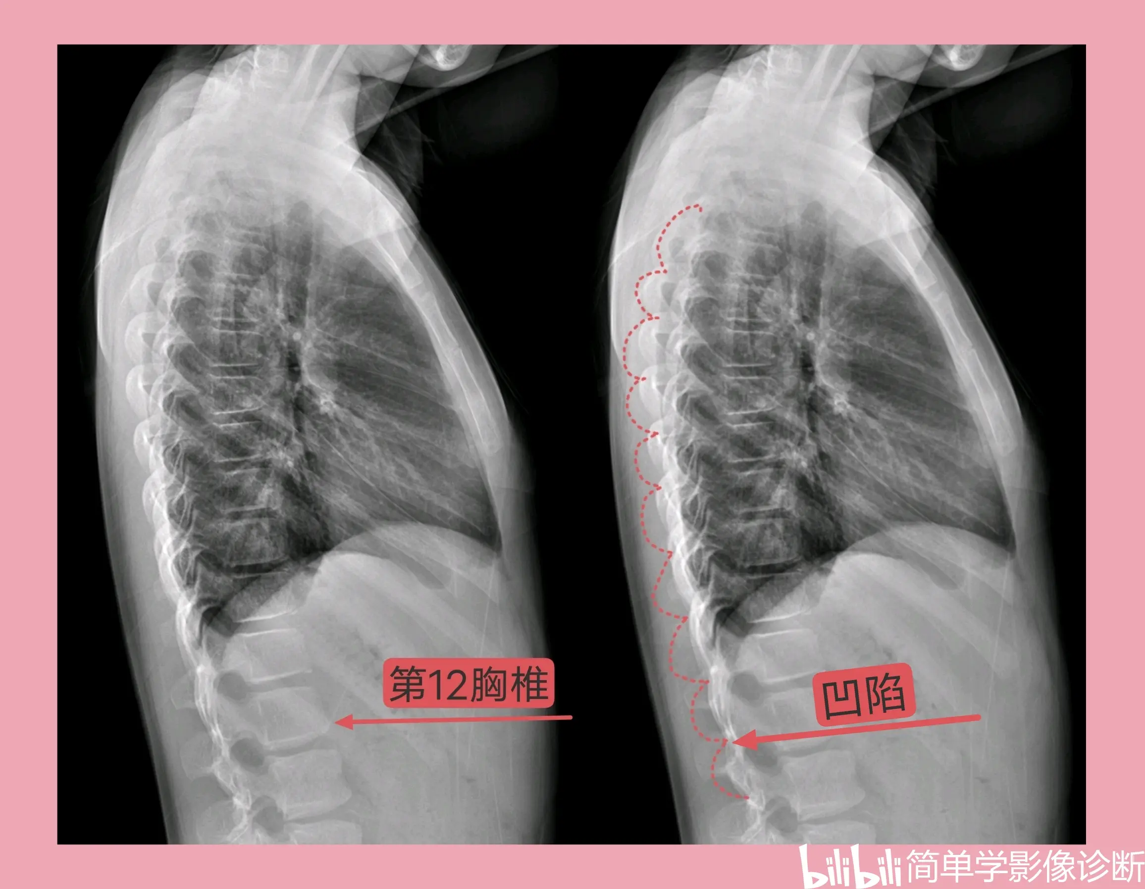 胸椎12在哪个位置图片图片