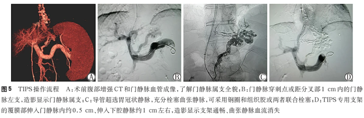(TIPS术)经颈静脉肝内门体静脉分流术治疗门静脉高压专家共识(2022年版) - 哔哩哔哩