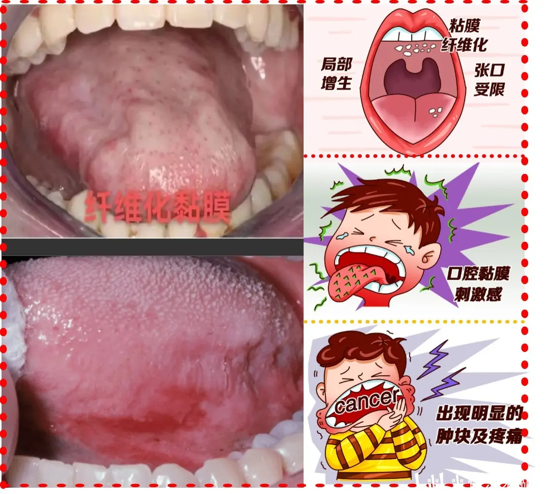 魏英杰:口腔黏膜下纤维化有什么症状