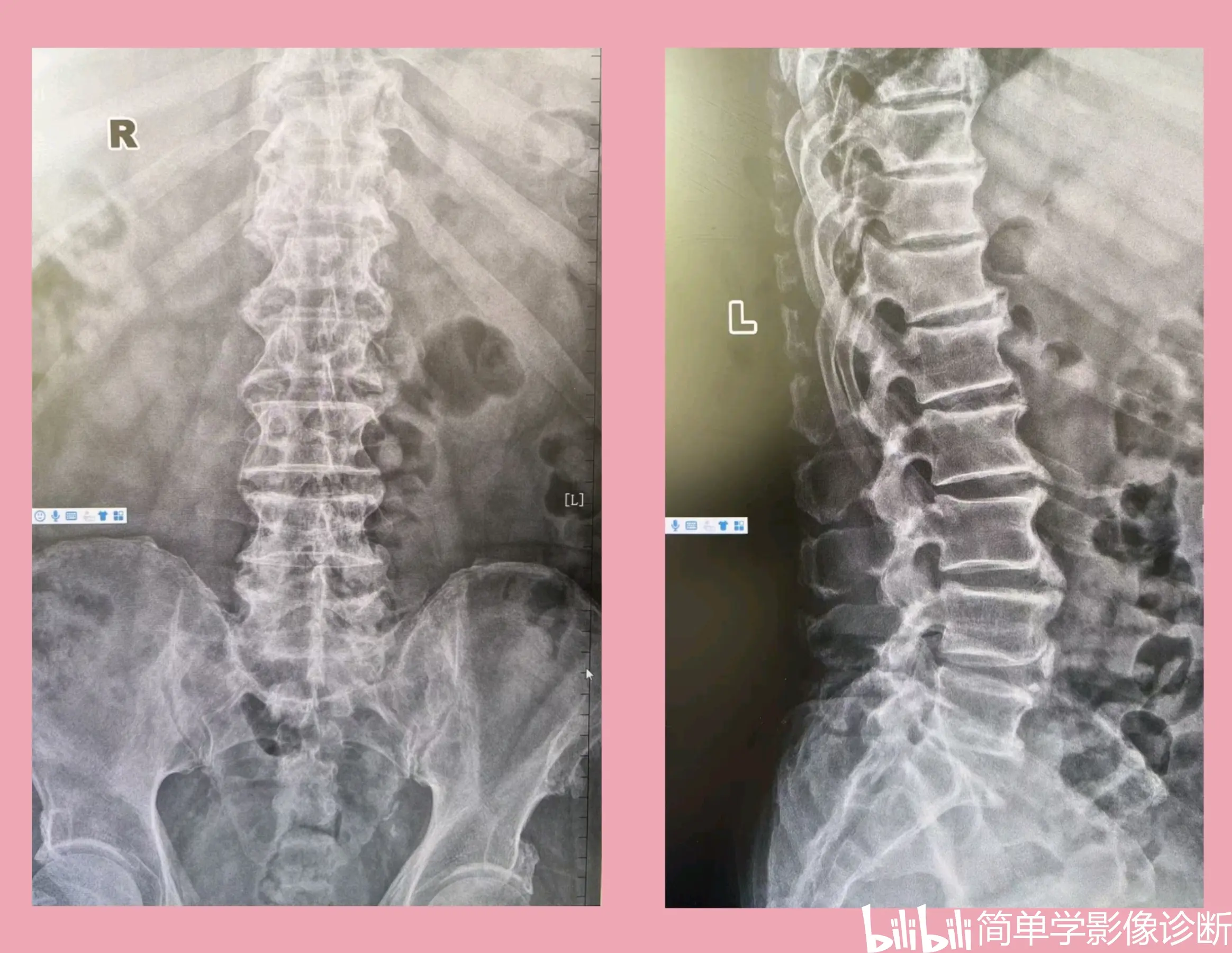骨盆正位,腰椎正侧位(弥漫性特发性骨肥厚)