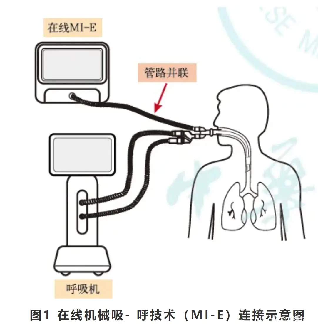 mi-e,实现了管路与呼吸机管路的并联