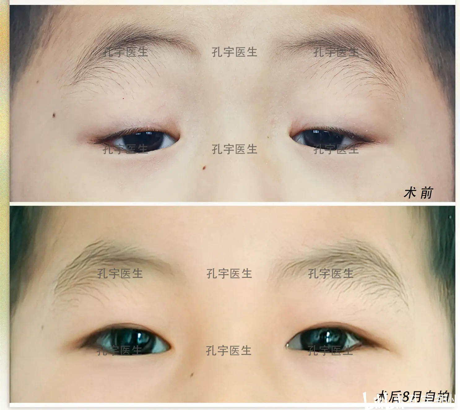孔宇:5岁小帅哥,双眼先天性重度上睑下垂