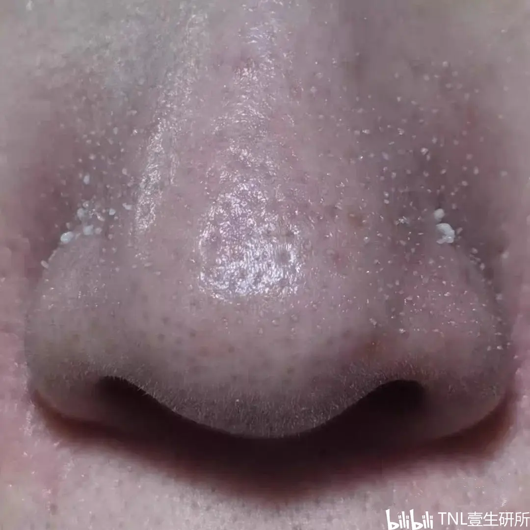 鼻子毛孔里挤出一条条白色的东西,是螨虫吗?