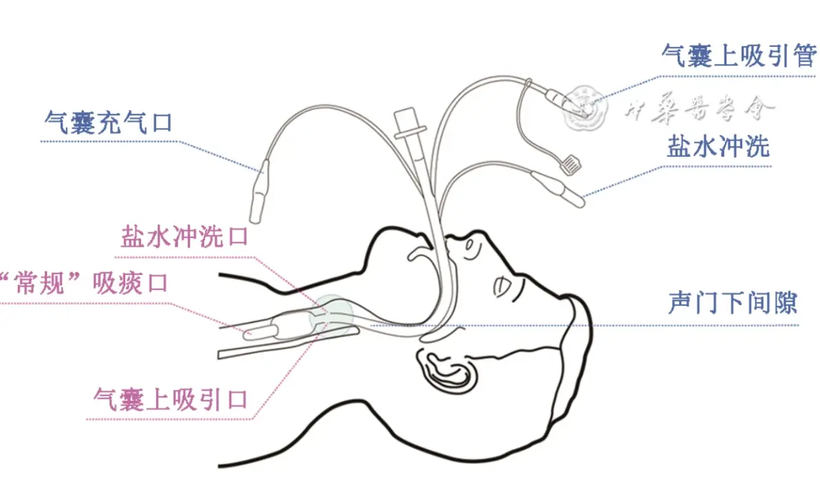 该设备在周期内自动运行,从声门下空间采集空气样本以测量co2浓度并